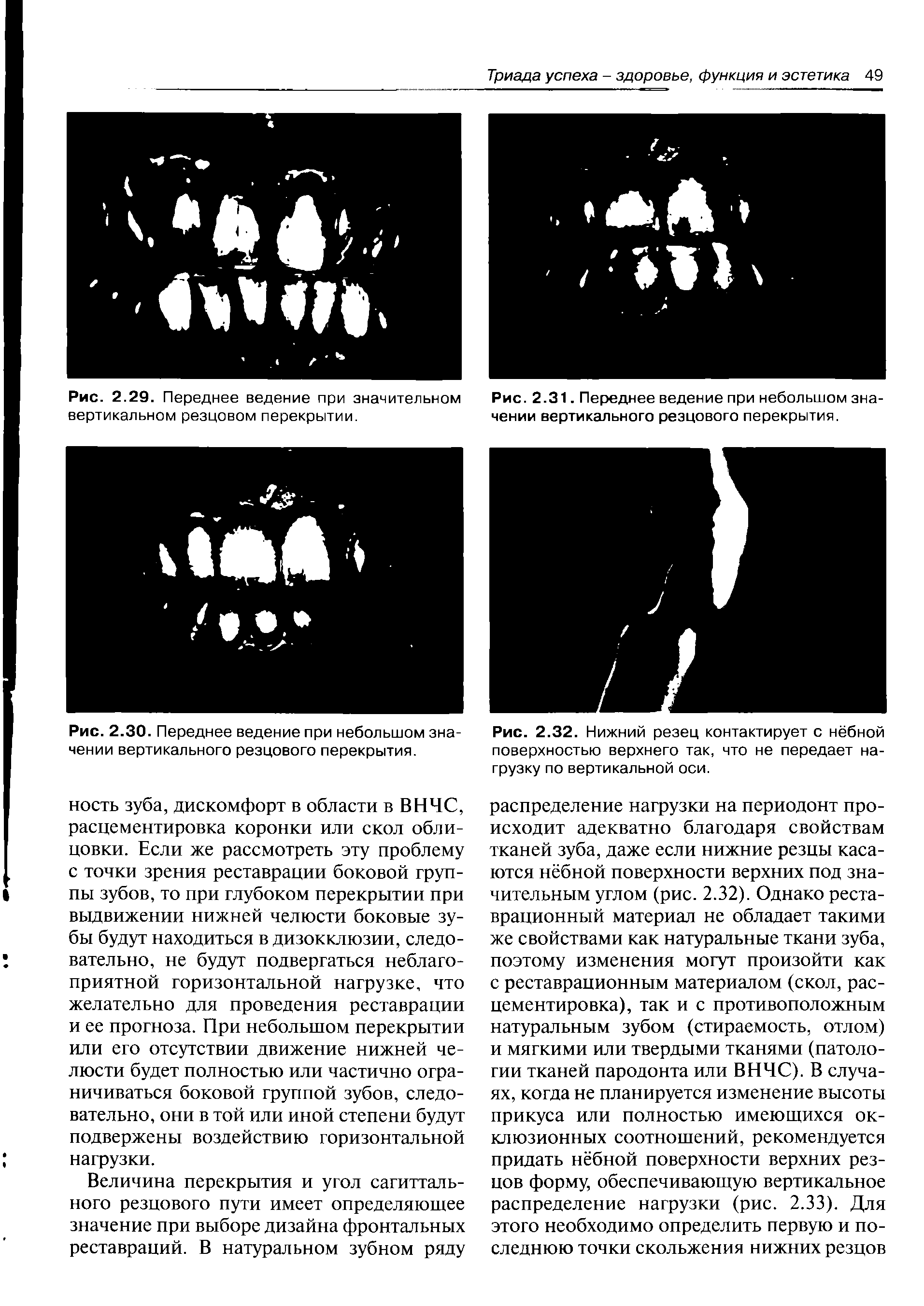 Рис. 2.32. Нижний резец контактирует с нёбной поверхностью верхнего так, что не передает нагрузку по вертикальной оси.