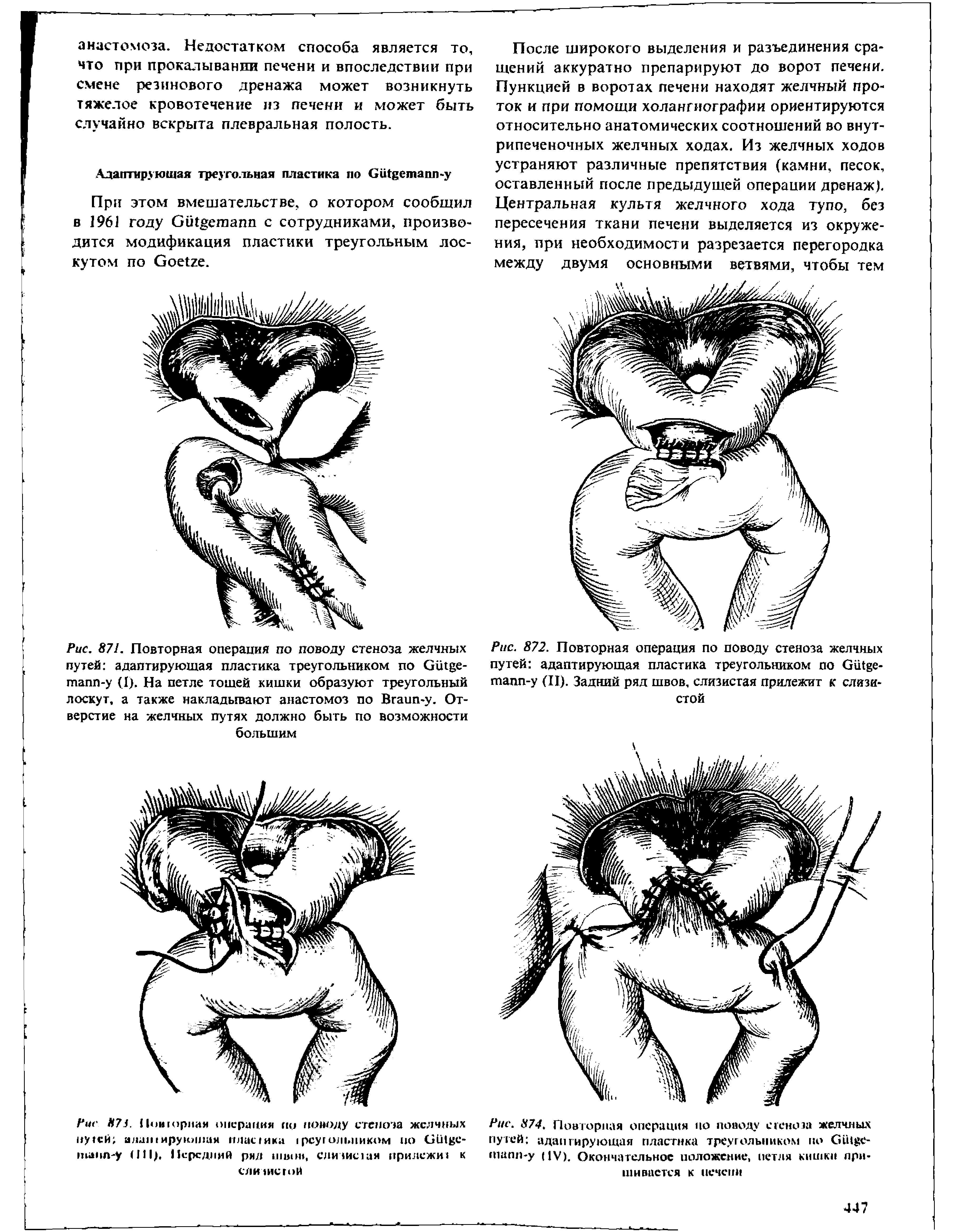 Рис. 871. Повторная операция по поводу стеноза желчных путей адаптирующая пластика треугольником по С1 е-тапп-у (I). На петле тощей кишки образуют треугольный лоскут, а также накладывают анастомоз по Вгаип-у. Отверстие на желчных путях должно быть по возможности большим...