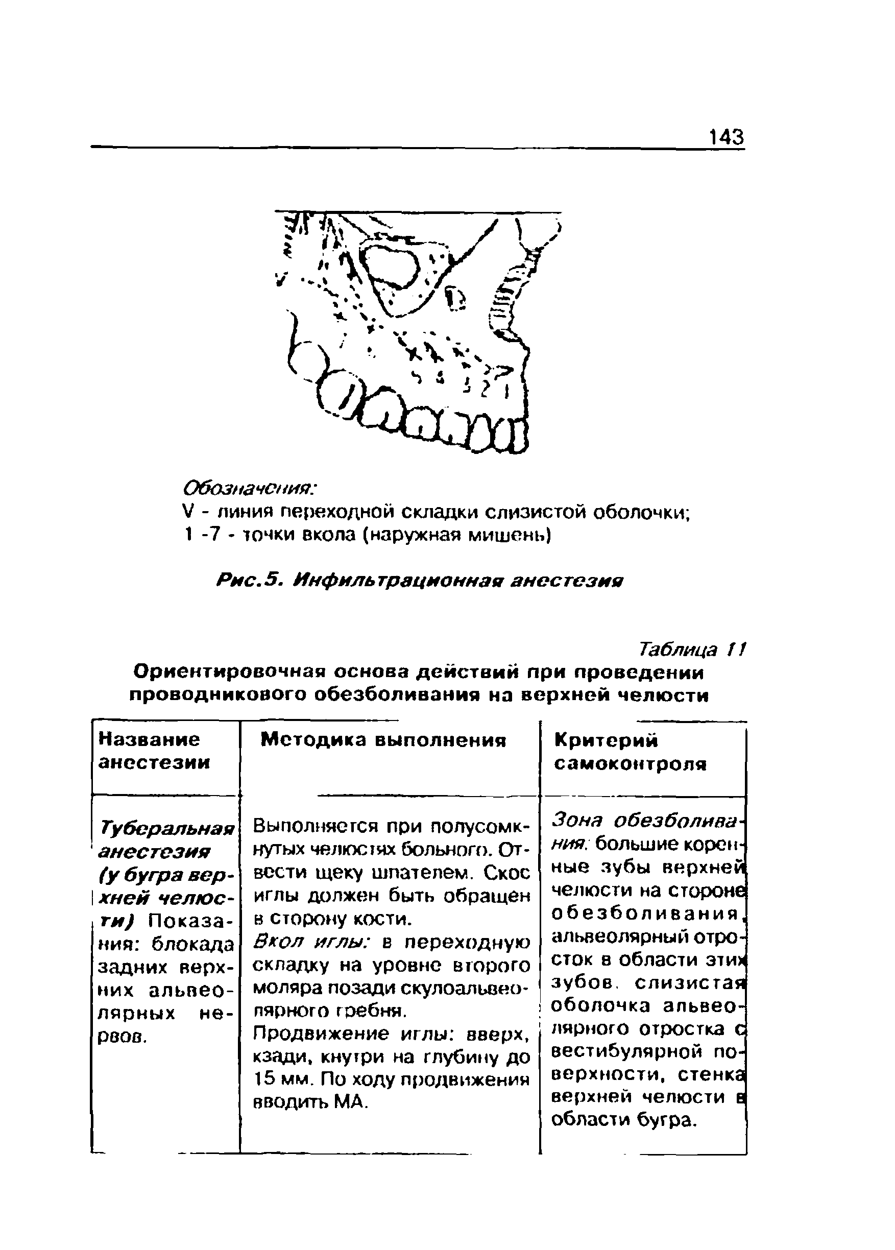 Таблица 11 Ориентировочная основа действий при проведении проводникового обезболивания на верхней челюсти...