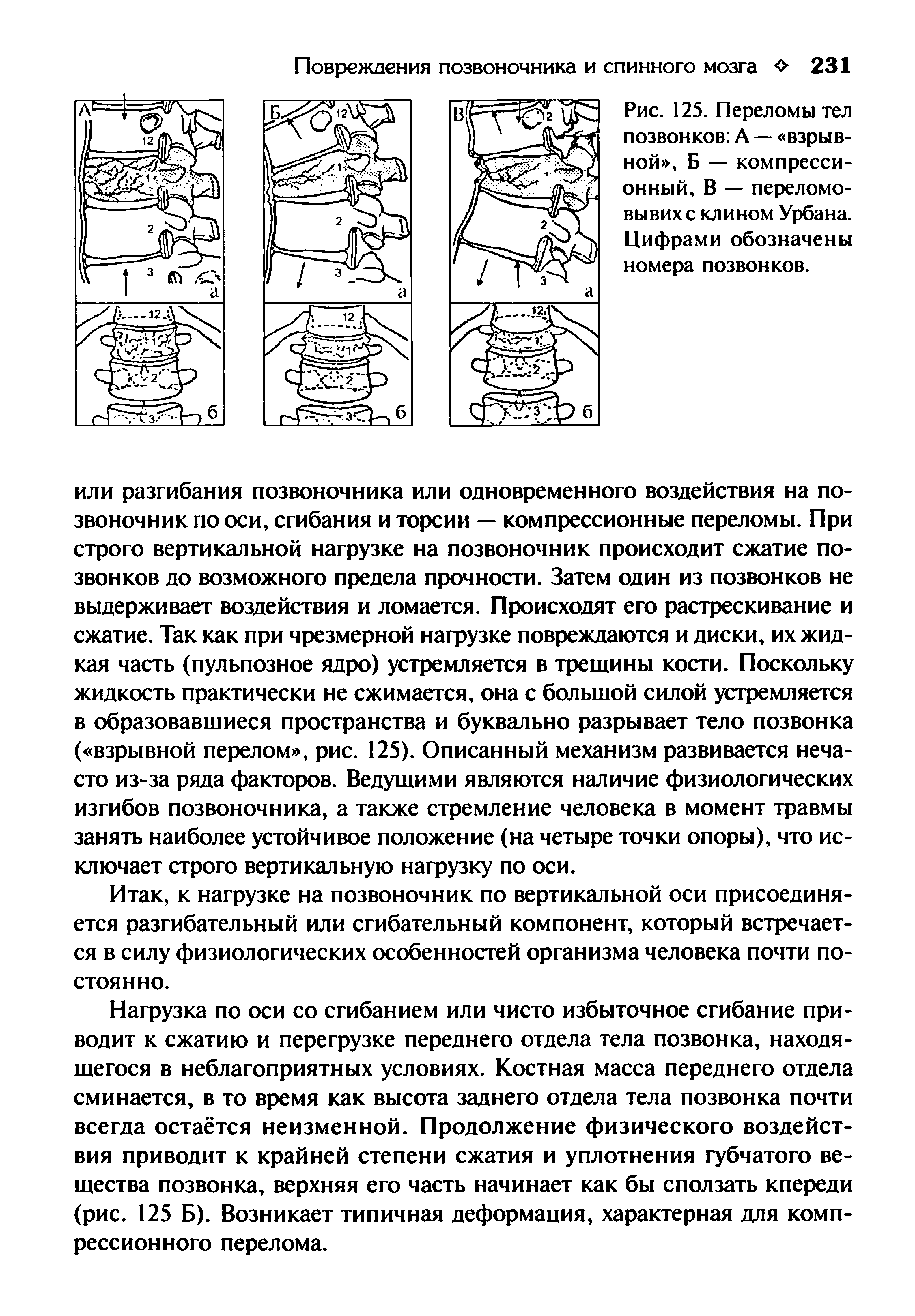 Рис. 125. Переломы тел позвонков А — взрывной , Б — компрессионный, В — переломовывихе клином Урбана. Цифрами обозначены номера позвонков.