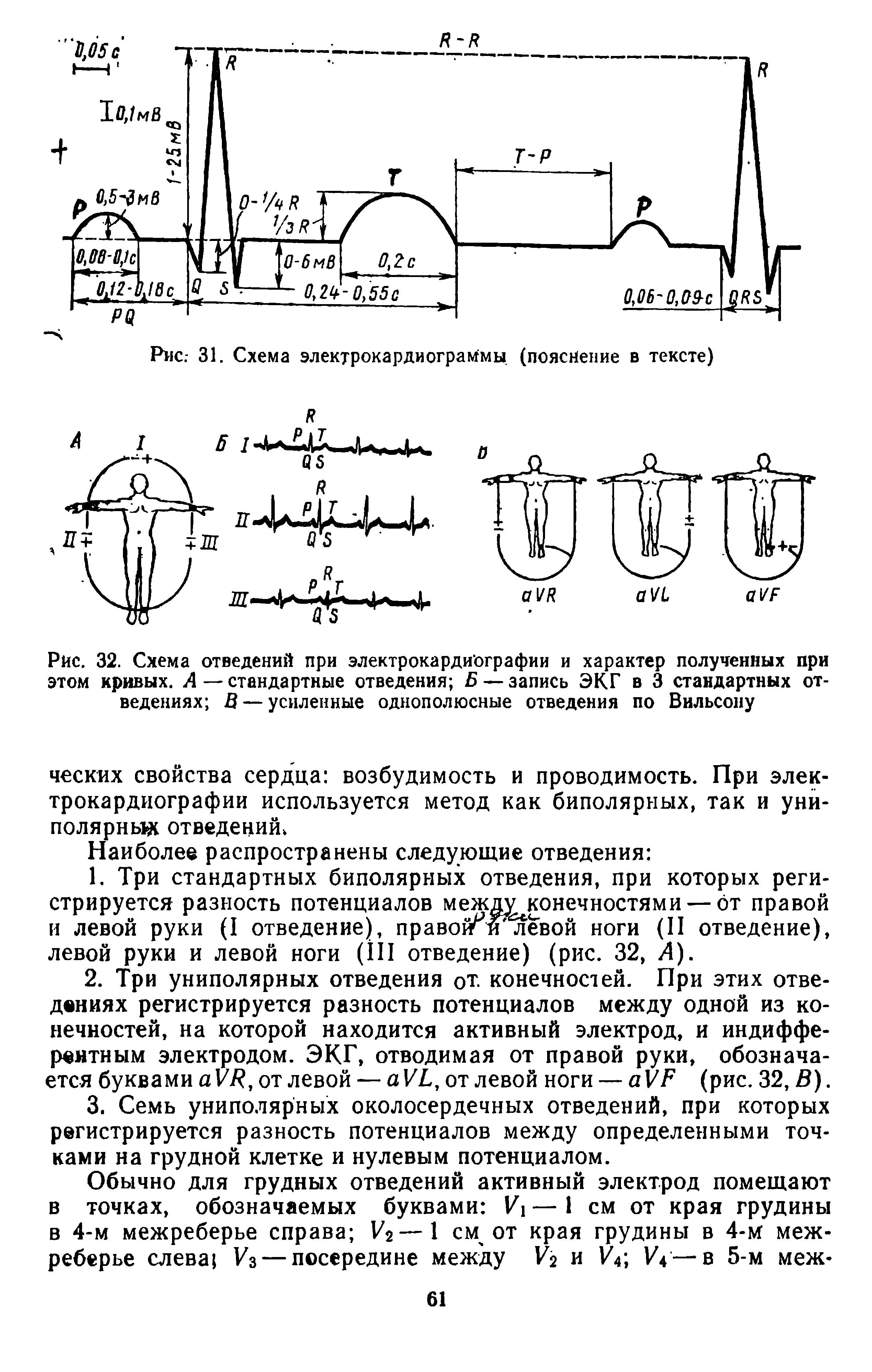 Рис. 32. Схема отведений при электрокардиографии и характер полученных при этом кривых. А — стандартные отведения Б — запись ЭКГ в 3 стандартных отведениях В — усиленные однополюсные отведения по Вильсону...