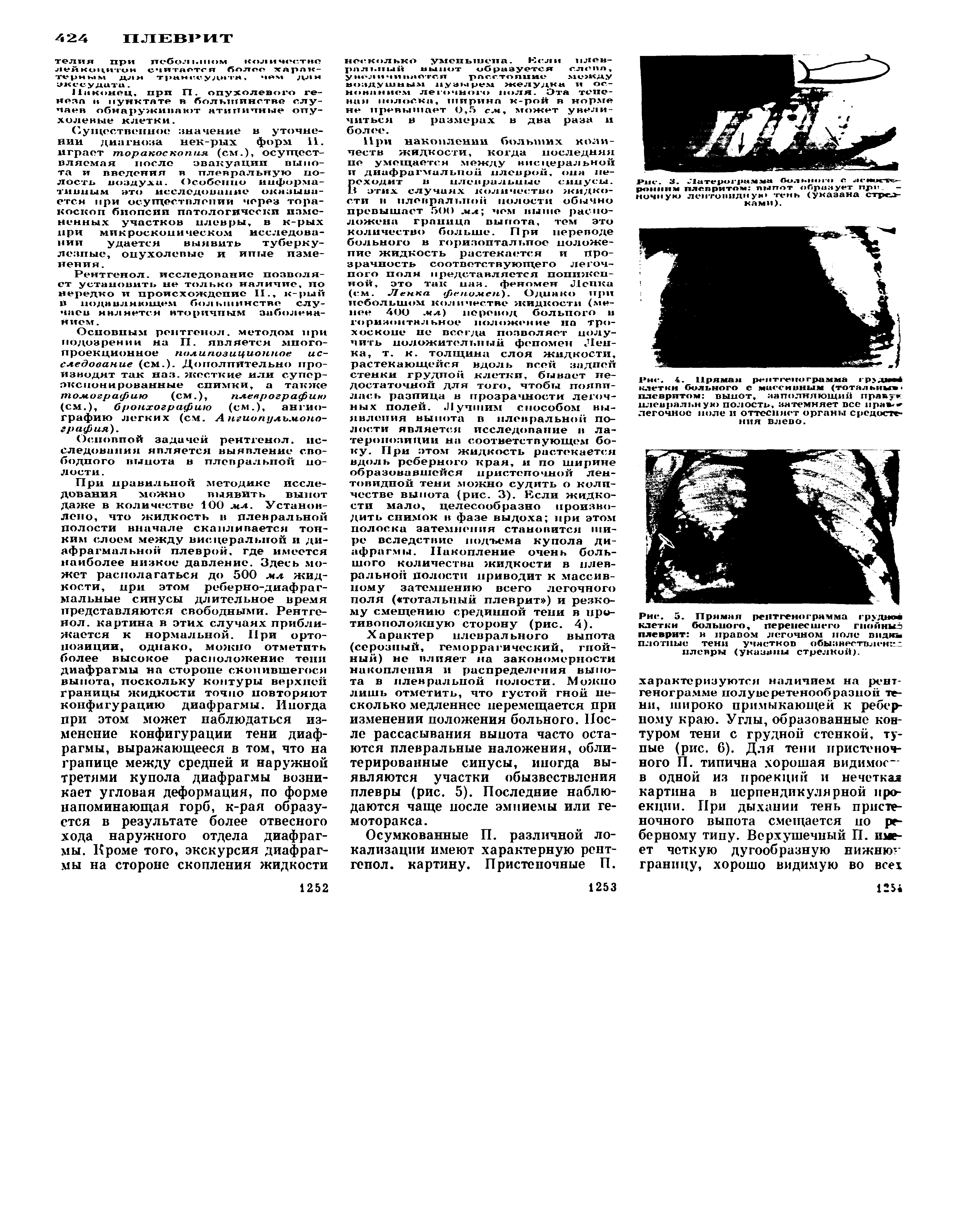 Рис. 5. Прямая рентгенограмма грудное клетки больного, перенесшего гнойны плеврит и правом легочном поле виджь плотные тенн участков обызвествление плевры (указаны стрелкой).