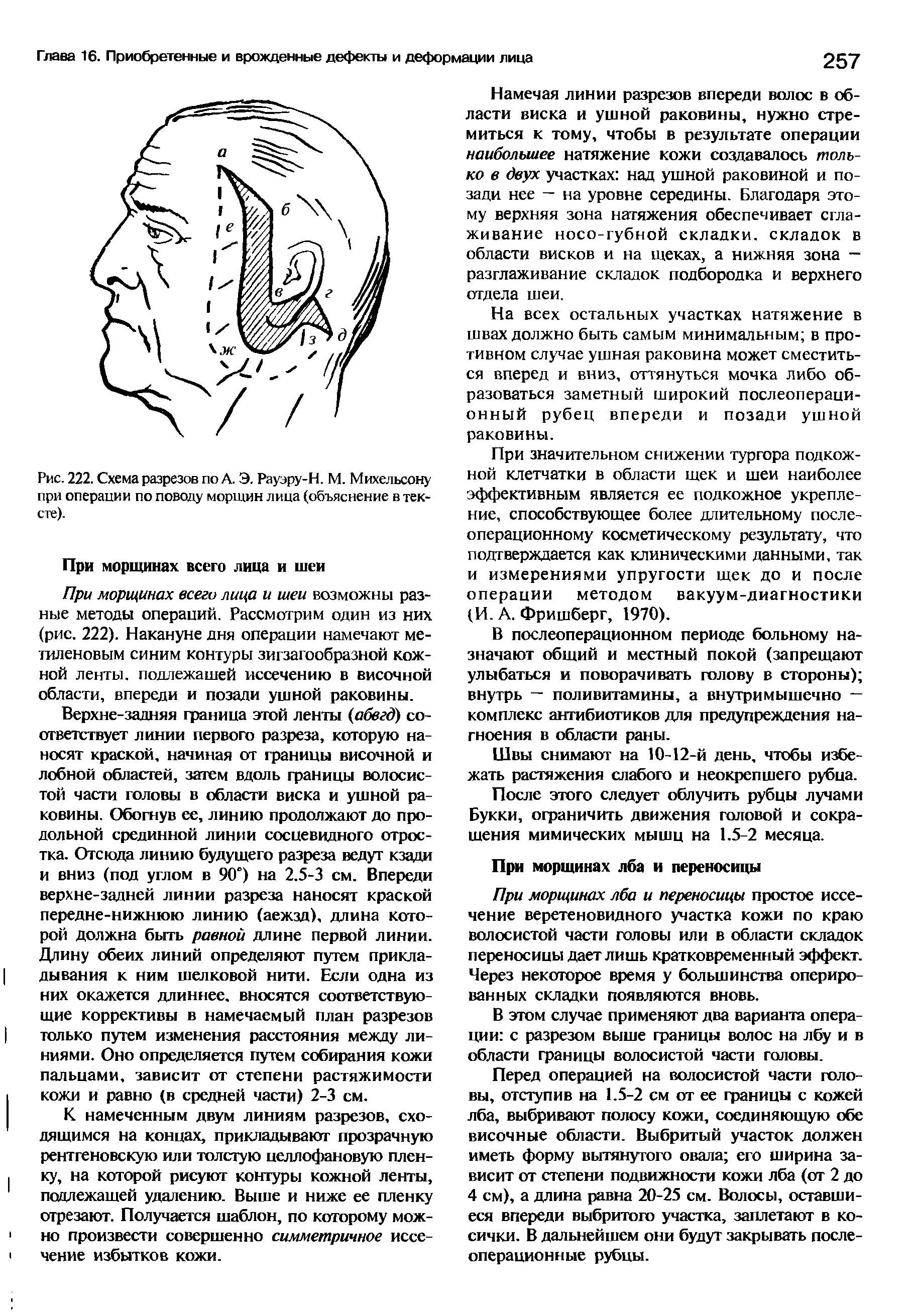 Рис. 222. Схема разрезов по А. Э. Рауэру-Н. М. Михельсону при операции по поводу морщин лица (объяснение в тексте).