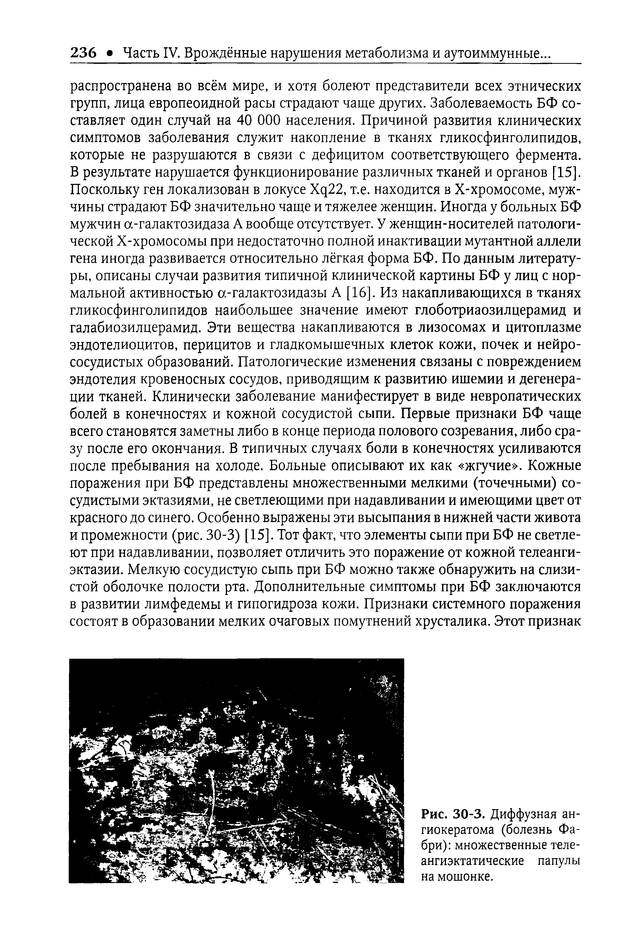 Рис. 30-3. Диффузная ан-гиокератома (болезнь Фабри) множественные теле-ангиэктатические папулы на мошонке.