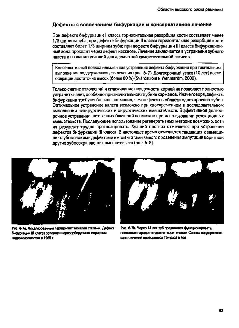 Рис. . Локалиэмаиный пародонтит тяжелой степени. М бифуркации IH класса заполнен иереэорбтвдви 1 лориспш гидроксиапатитом 1965 г...