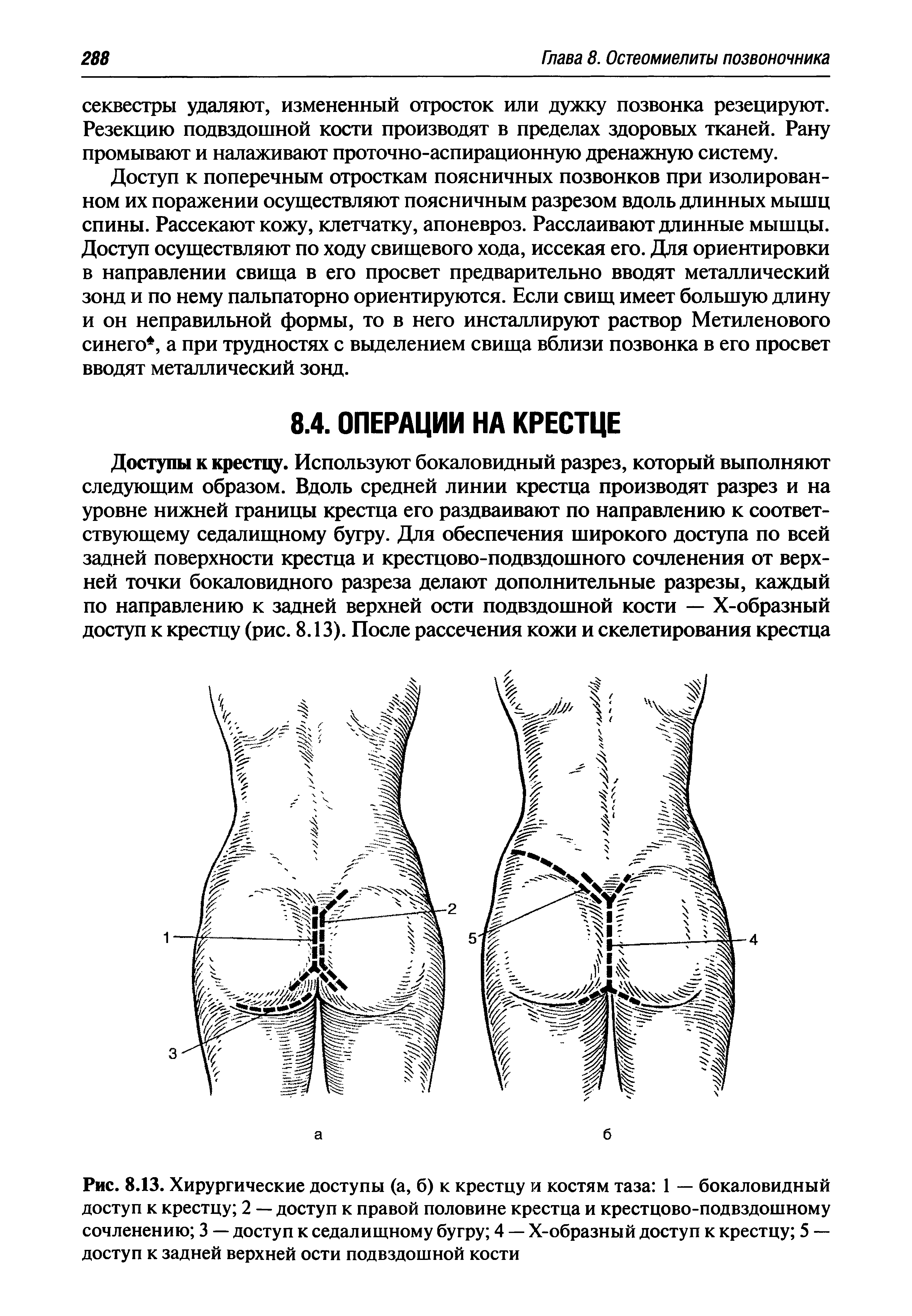 Рис. 8.13. Хирургические доступы (а, б) к крестцу и костям таза 1 — бокаловидный доступ к крестцу 2 — доступ к правой половине крестца и крестцово-подвздошному сочленению 3 — доступ к седалищному бугру 4 — Х-образный доступ к крестцу 5 — доступ к задней верхней ости подвздошной кости...