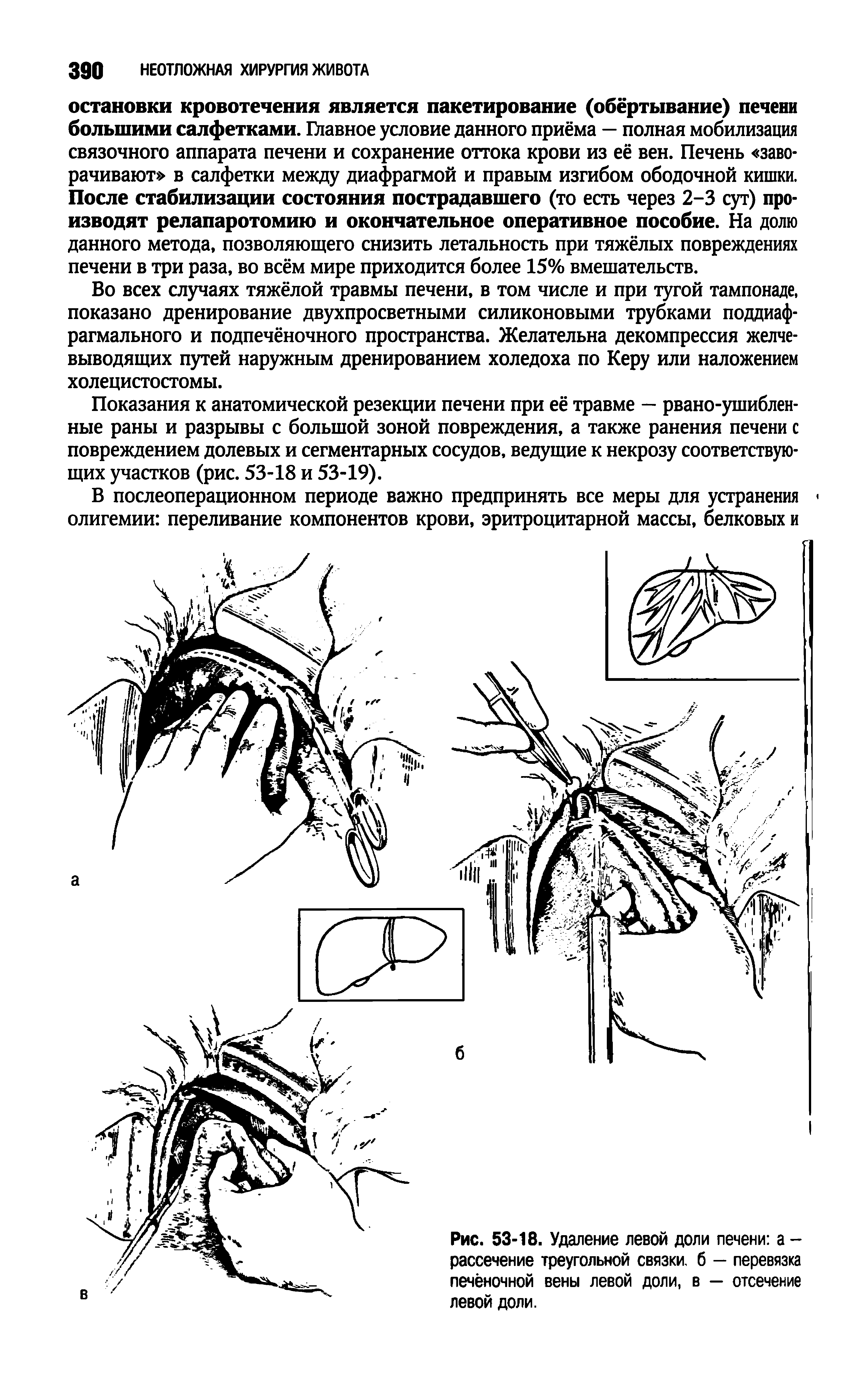 Рис. 53-18. Удаление левой доли печени а -рассечение треугольной связки, б — перевязка печёночной вены левой доли, в — отсечение левой доли.