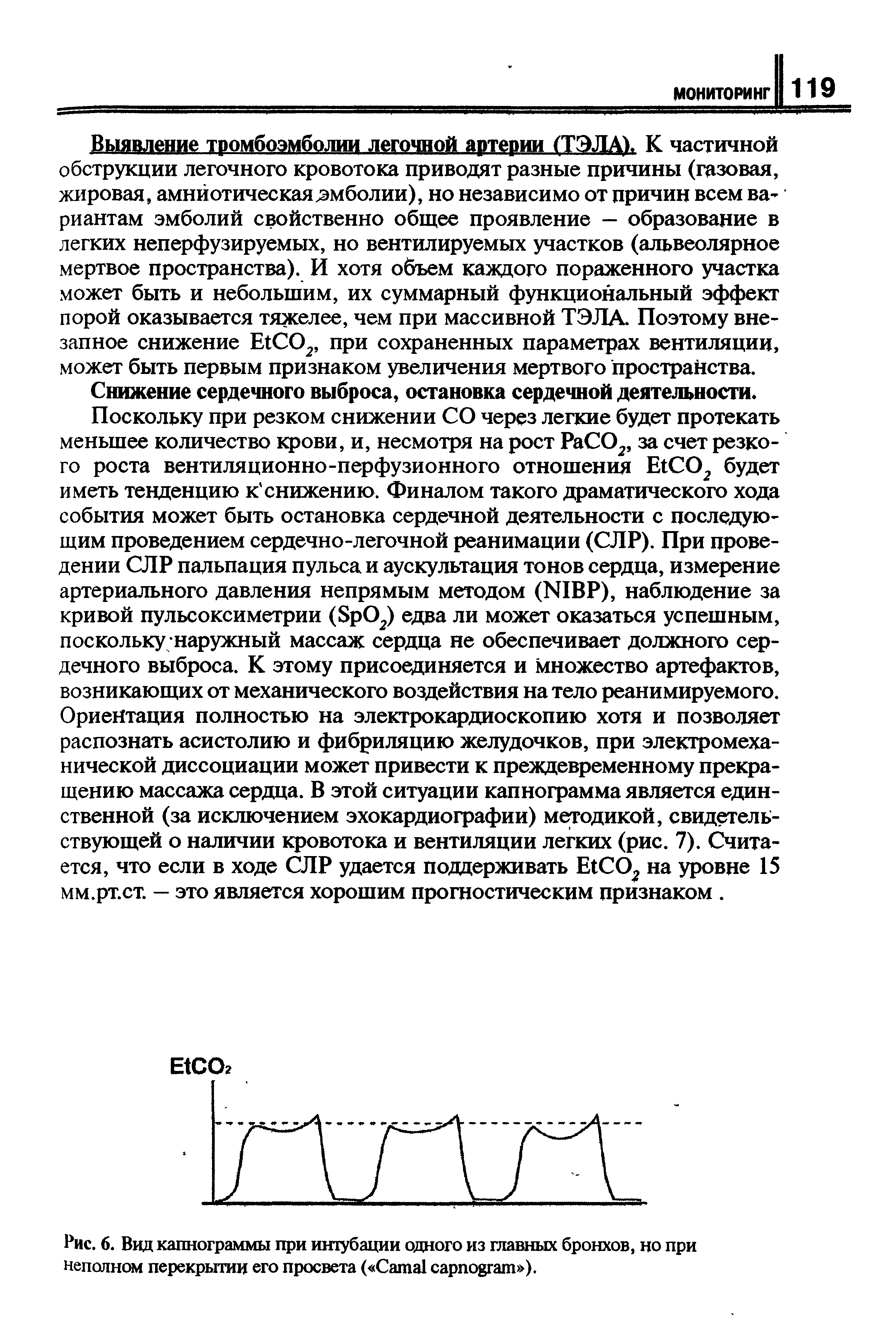 Рис. 6. Вид капнограммы при интубации одного из главных бронхов, но при неполном перекрытии его просвета ( C ).