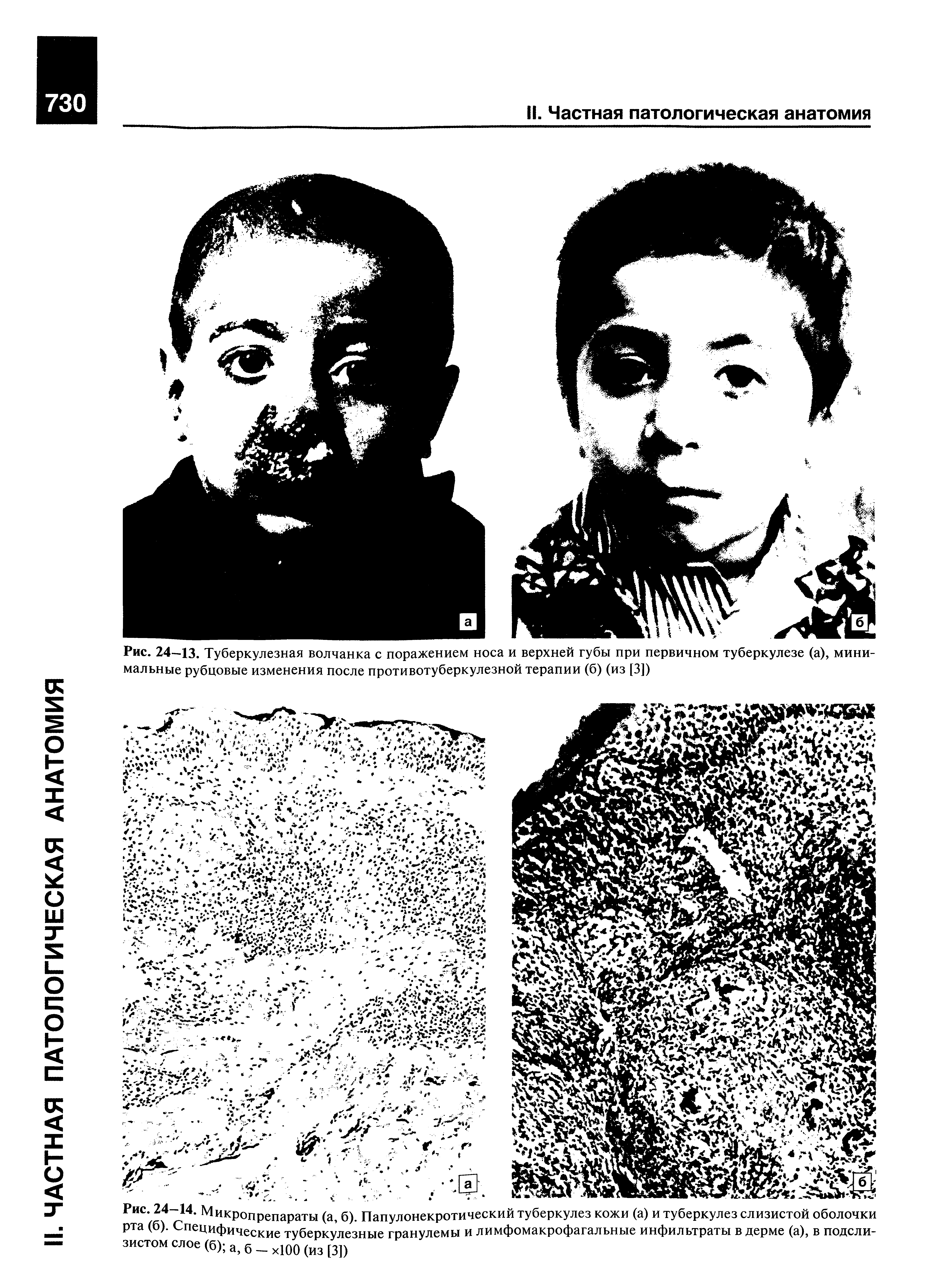 Рис. 24 14. Микропрепараты (а, б). Папулонекротический туберкулез кожи (а) и туберкулез слизистой оболочки рта (б). Специфические туберкулезные гранулемы и лимфомакрофагальные инфильтраты в дерме (а), в подсли-зистомслое(б) а,б х100(из[3])...