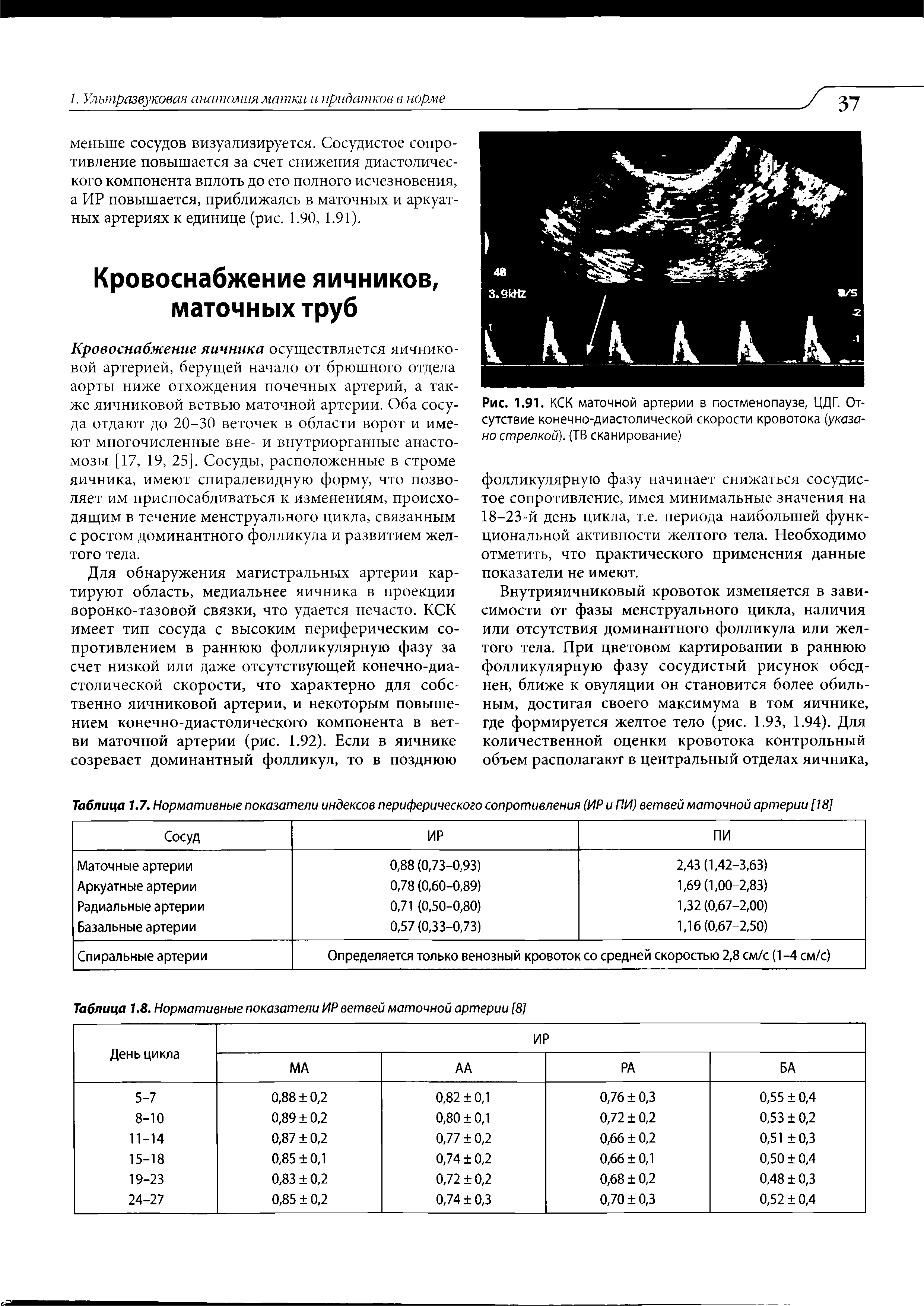 Рис. 1.91. КСК маточной артерии в постменопаузе, ЦДГ. Отсутствие конечно-диастолической скорости кровотока (указано стрелкой). (ТВ сканирование)...