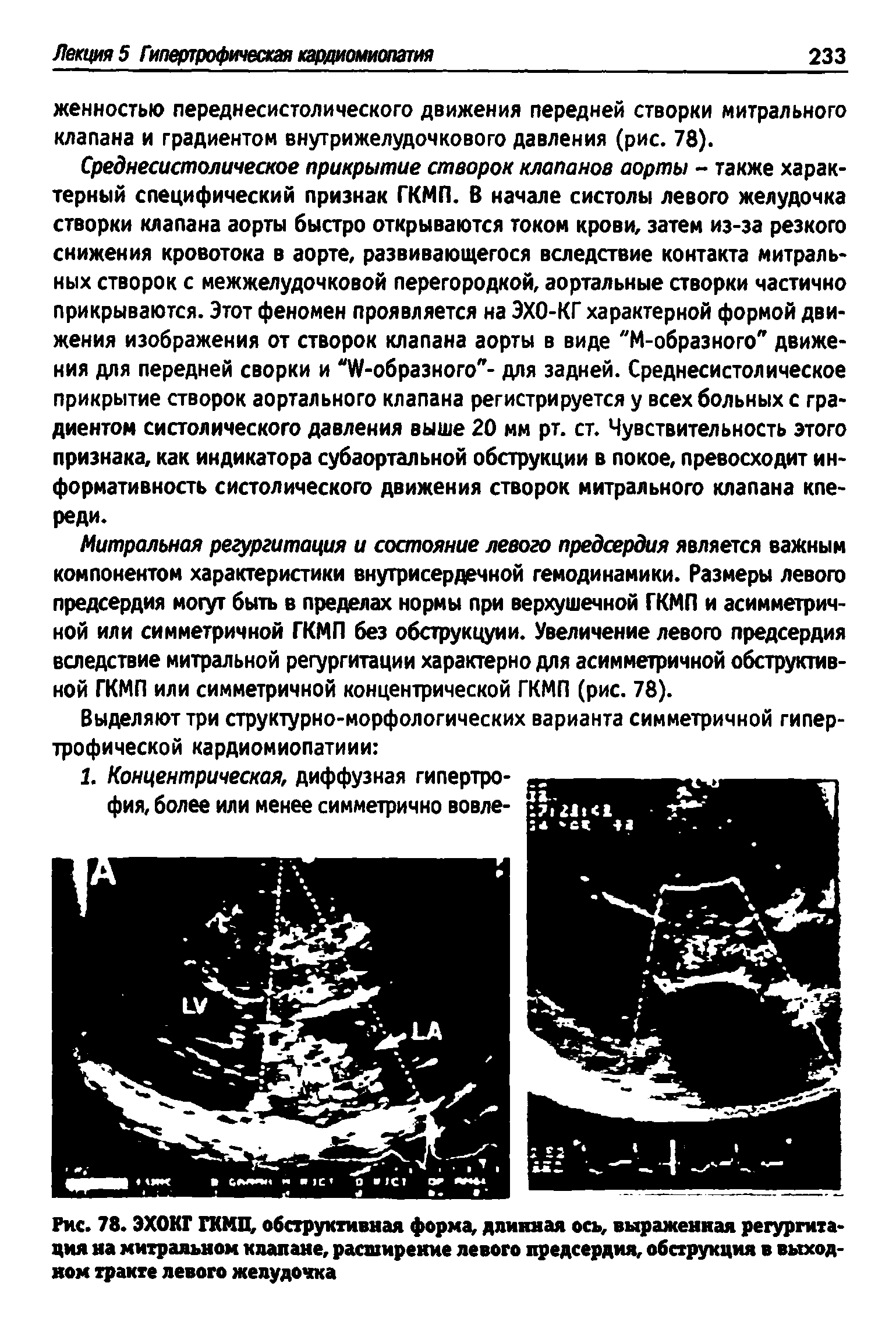 Рис. 78. ЭХОКГ ГКМП, обструктивная форма, длинная ось, выраженная регургитация на митральном клапане, расширение левого предсердия, обструкция в выходном тракте левого желудочка...