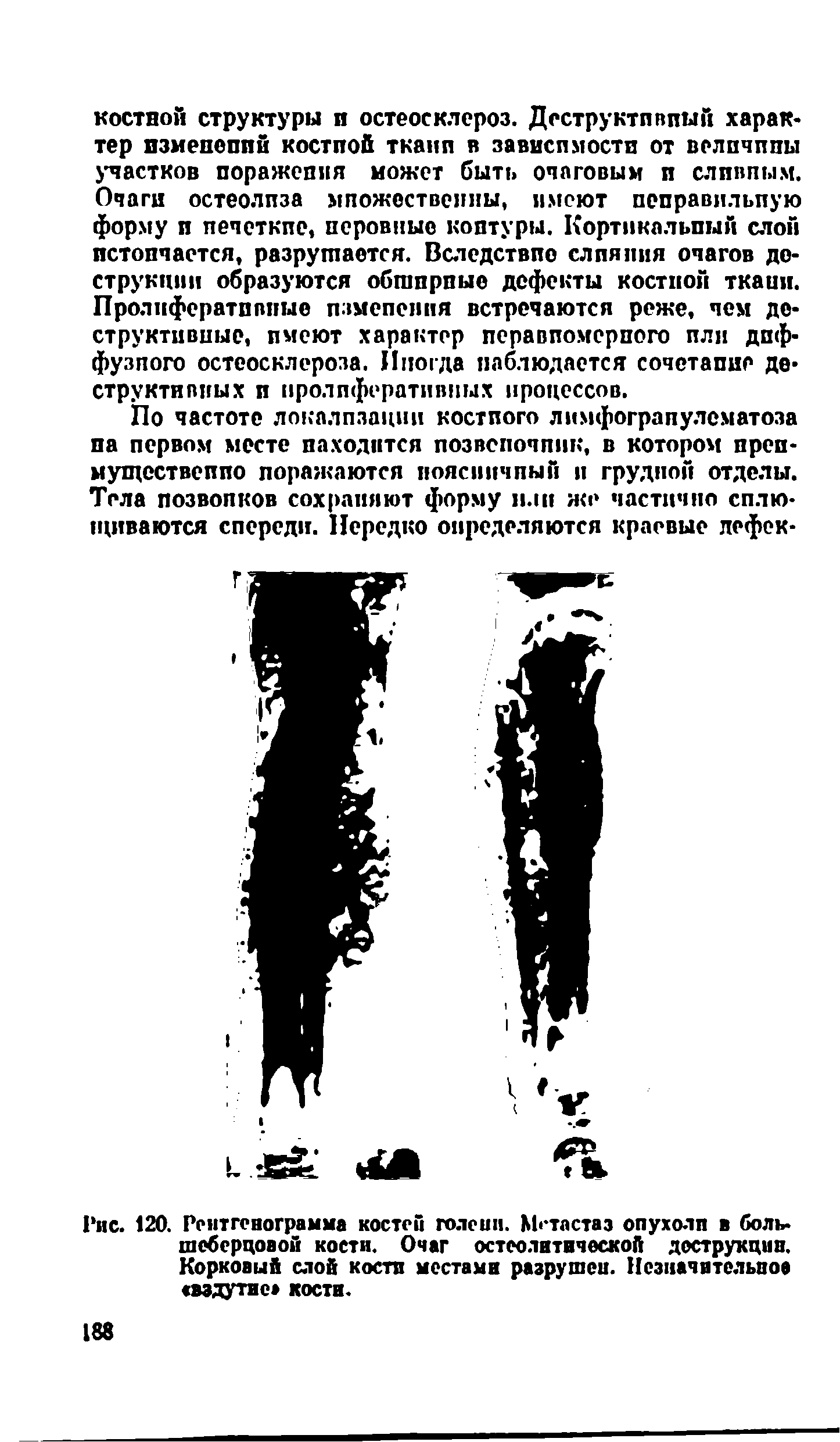 Рис. 120. Рентгенограмма костей голе и и. М<-тастаэ опухоли в боль-шеберцовой кости. Очаг остеолитической деструкции. Корковый слой кости местами разрушен. Незначительное вздутие кости.