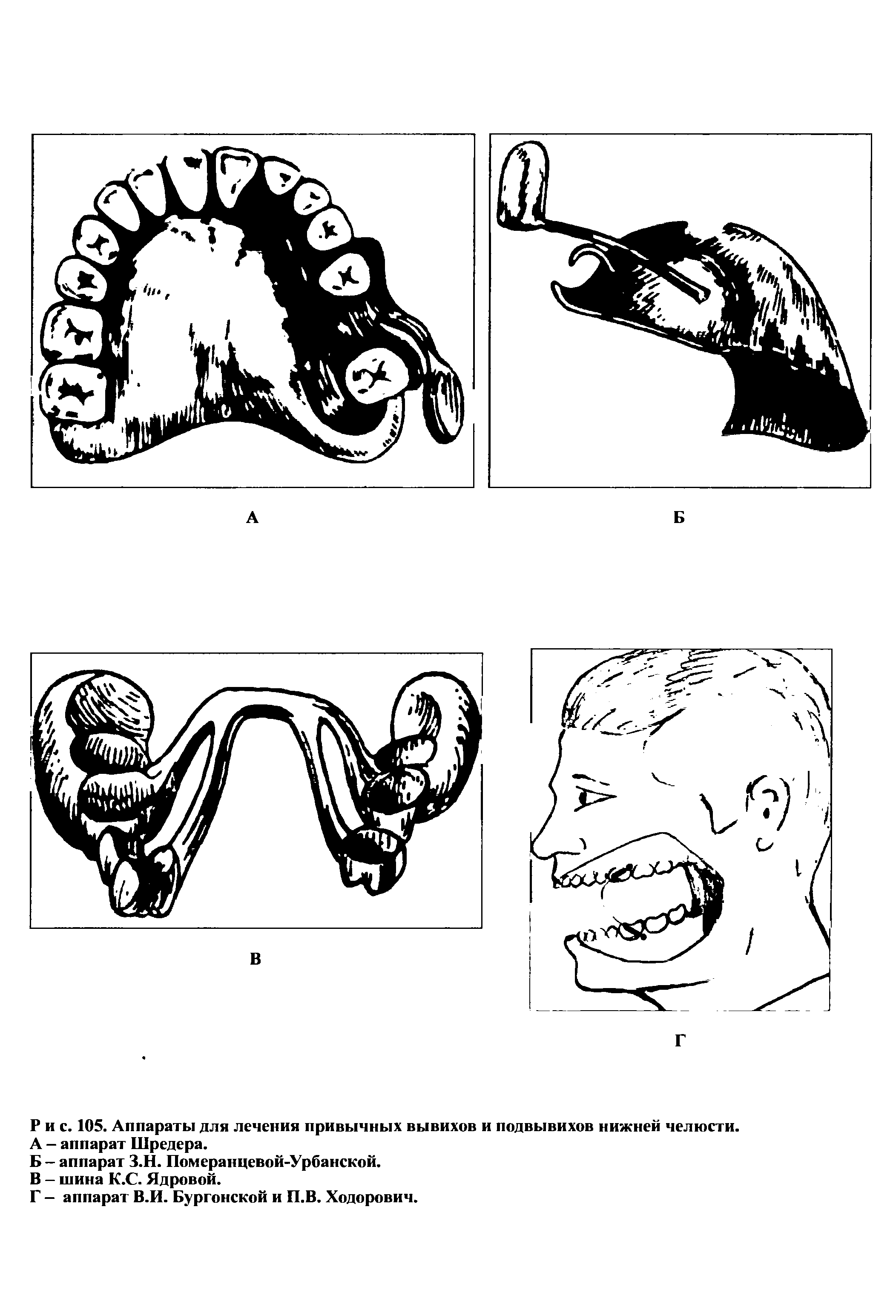 Рис. 105. Аппараты для лечения привычных вывихов и подвывихов нижней челюсти. А - аппарат Шредера.