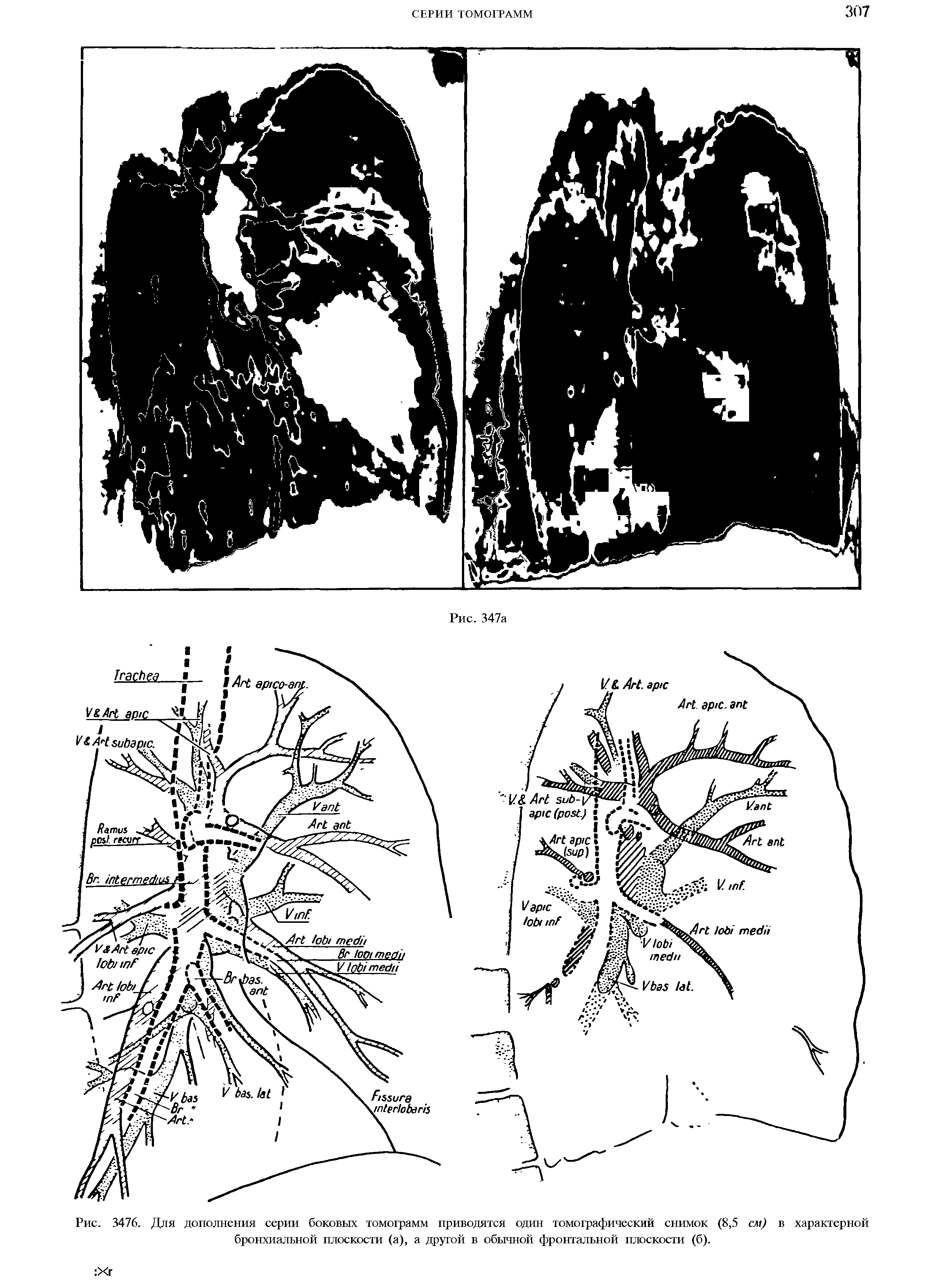 Рис. 3476. Для дополнения серии боковых томограмм приводятся один томографический снимок (8,5 см) в характерной бронхиальной плоскости (а), а другой в обычной фронтальной плоскости (б).
