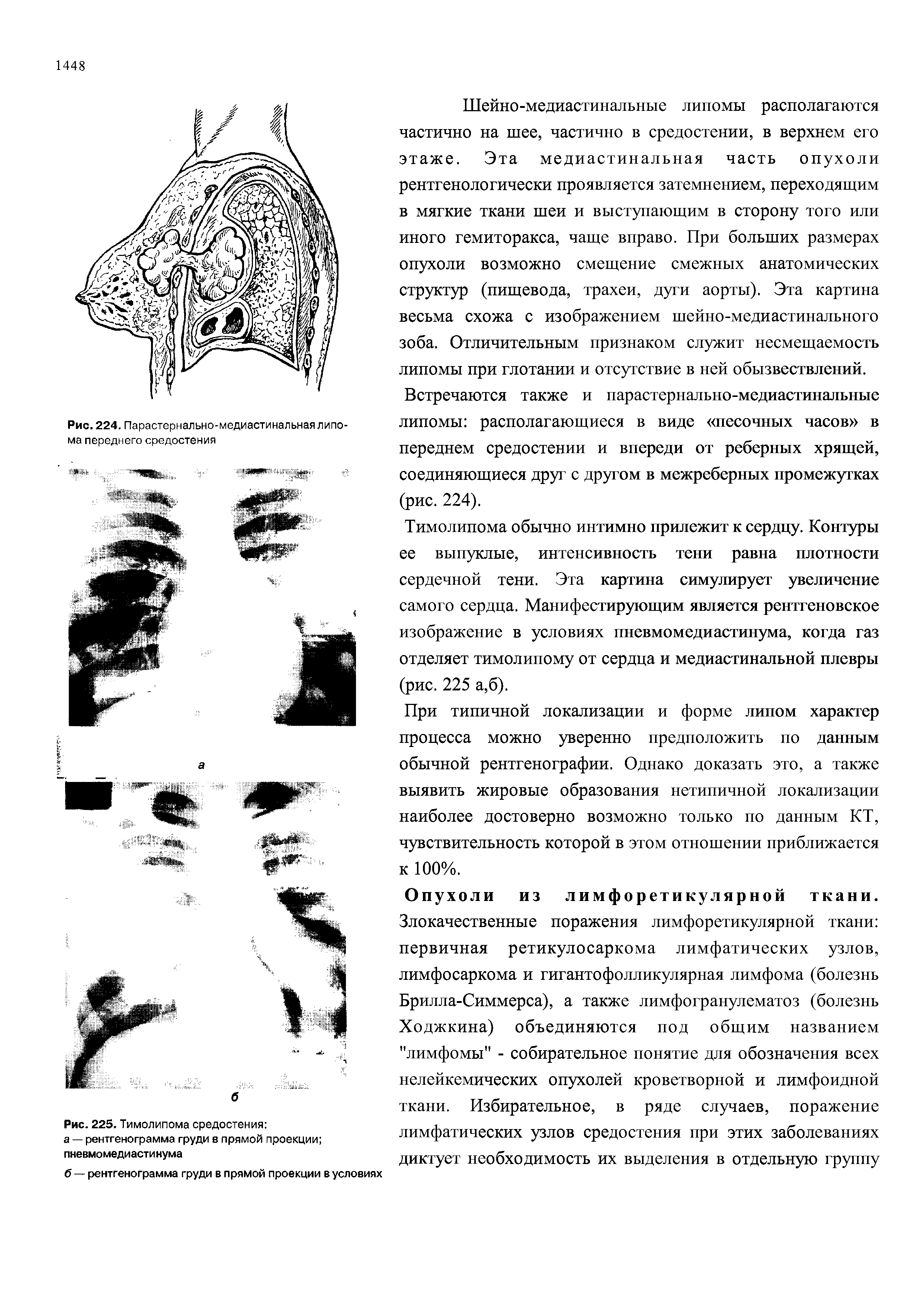 Рис. 225. Тимолипома средостения а — рентгенограмма груди в прямой проекции пневмомедиастинума...