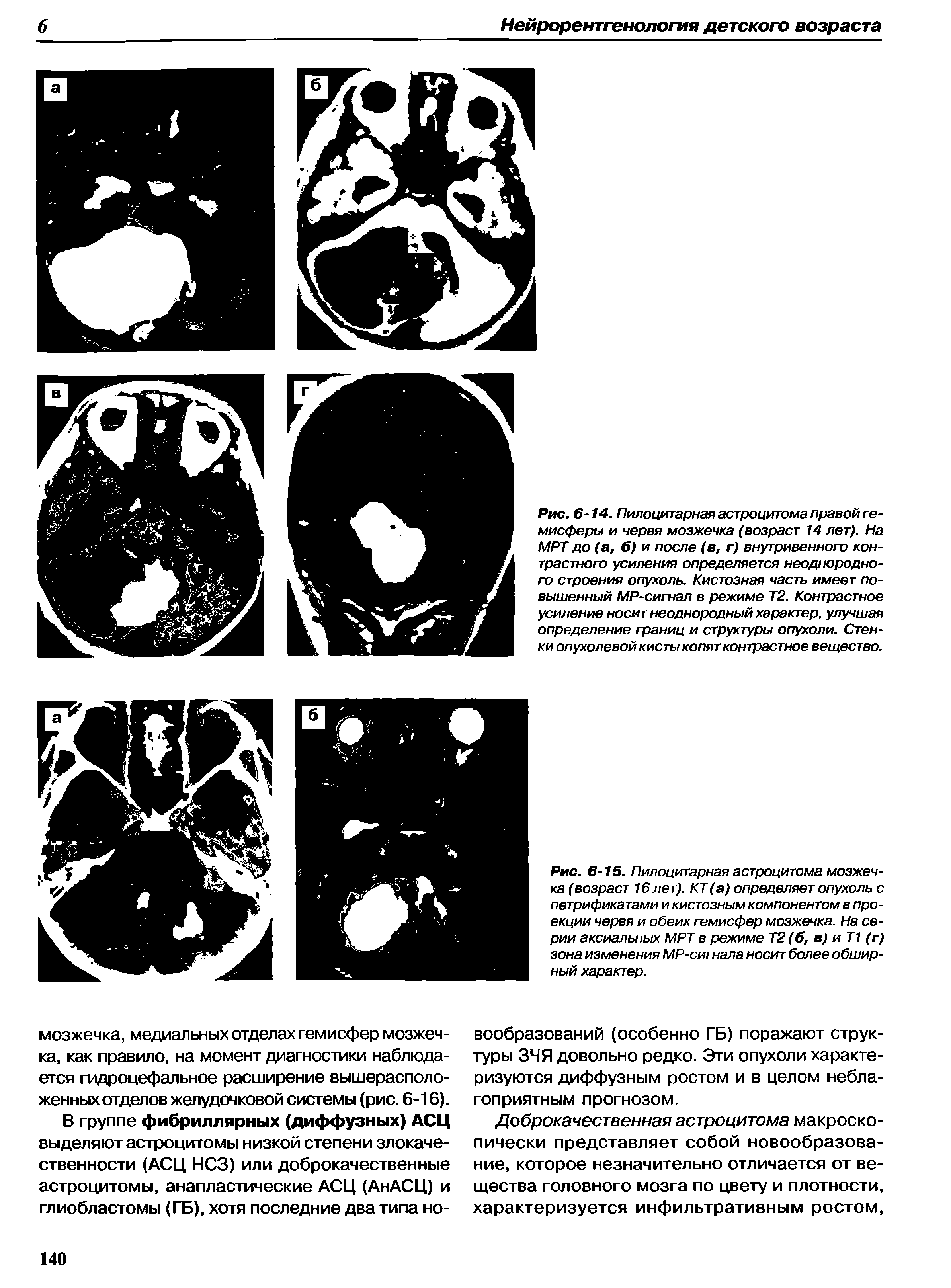 Рис. 6-15. Пилоцитарная астроцитома мозжечка (возраст 16 лет). КТ (а) определяет опухоль с петрификатами и кистозным компонентом в проекции червя и обеих гемисфер мозжечка. На серии аксиальных МРТ в режиме Т2 (б, в) и Т1 (г) зона изменения MP-сигнала носит более обширный характер.