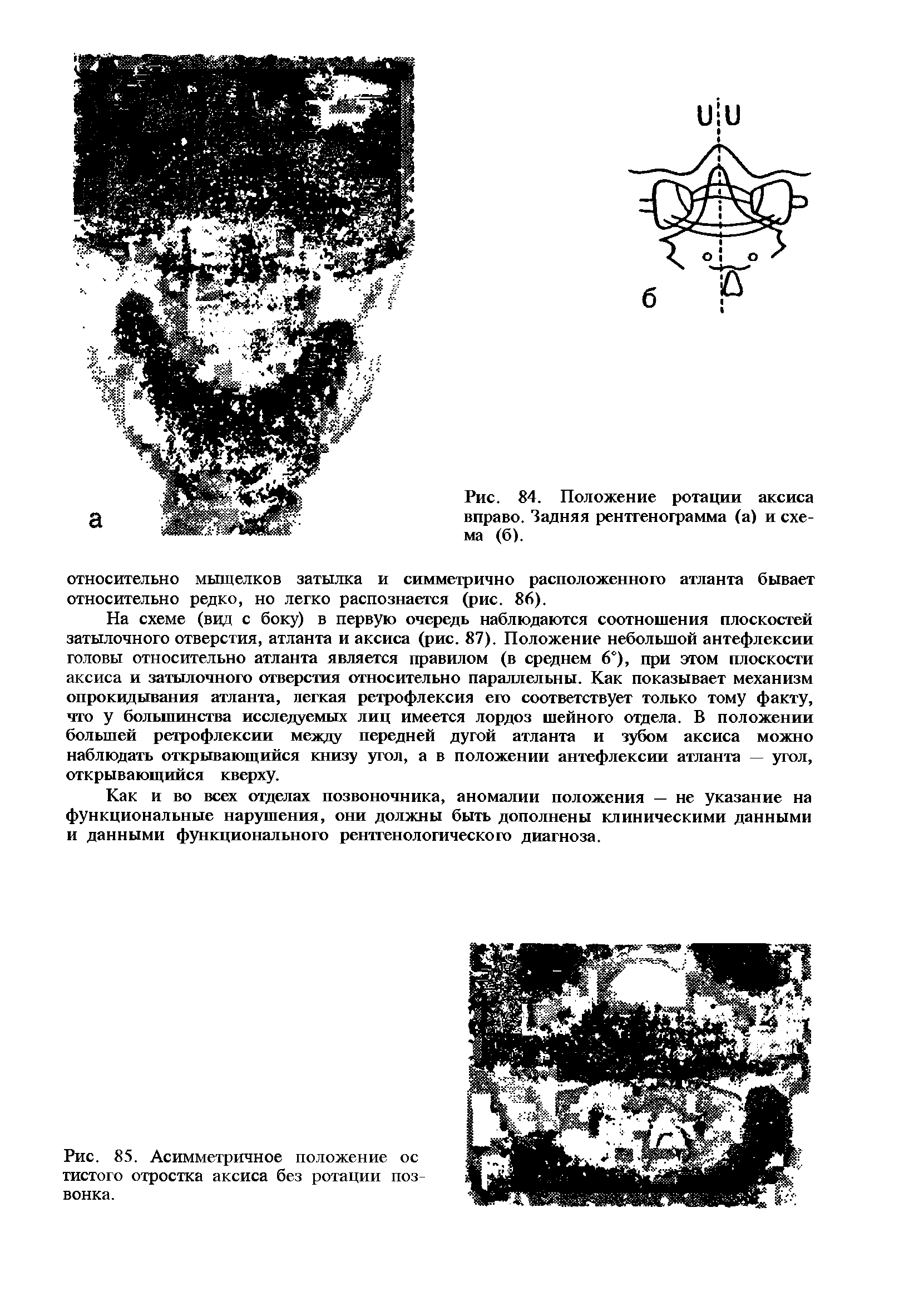 Рис. 85. Асимметричное положение ос тистого отростка аксиса без ротации позвонка.