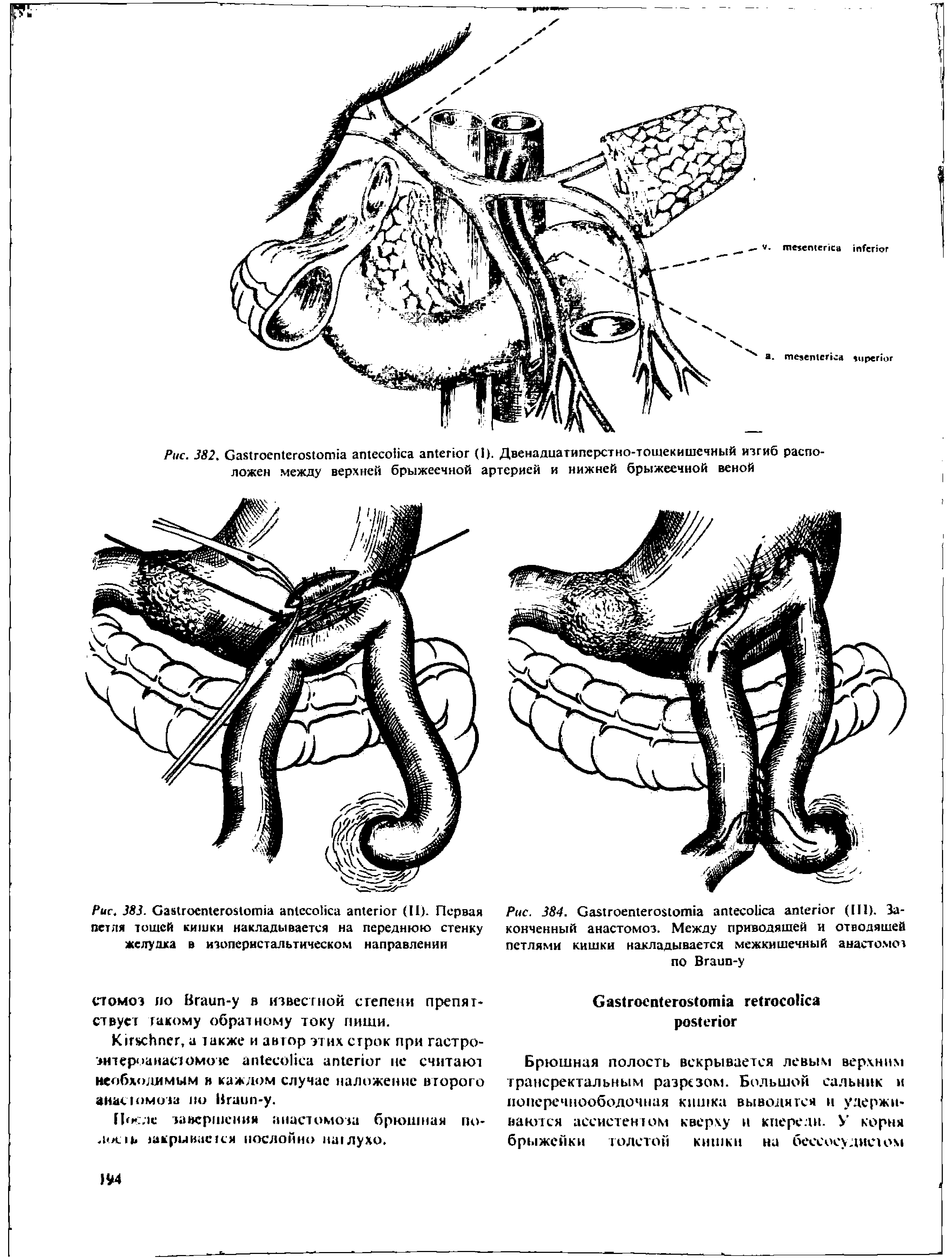 Рис. 383. G (II). Первая петля тошей кишки накладывается на переднюю стенку желудка в изоперистальтическом направлении...