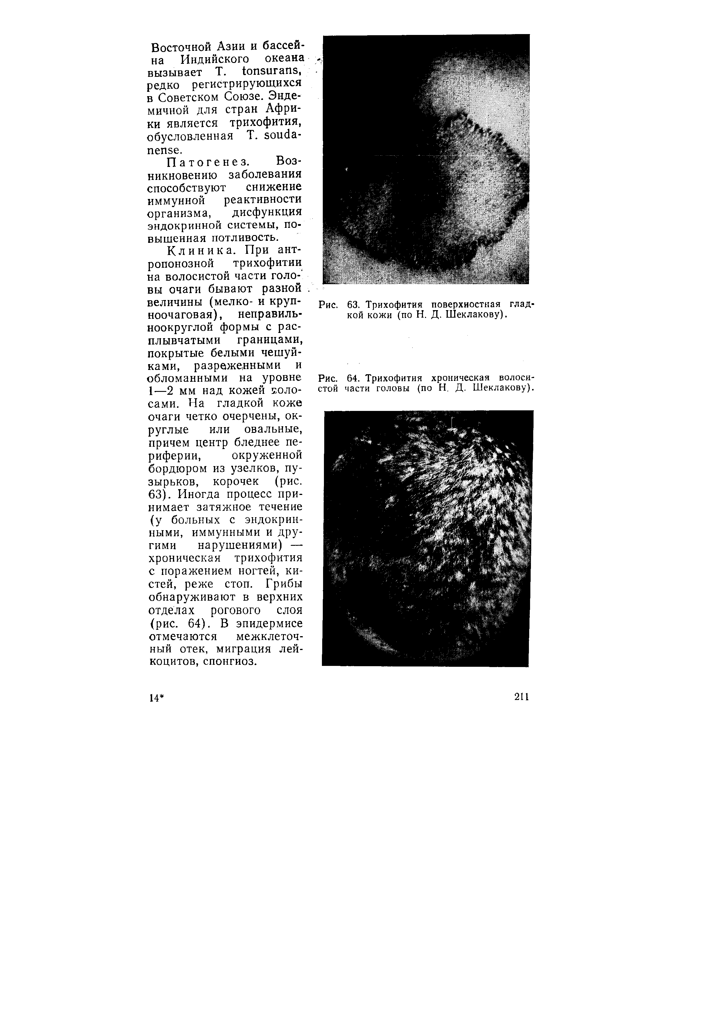 Рис. 64. Трихофития хроническая волосистой части головы (по Н. Д. Шеклакову).