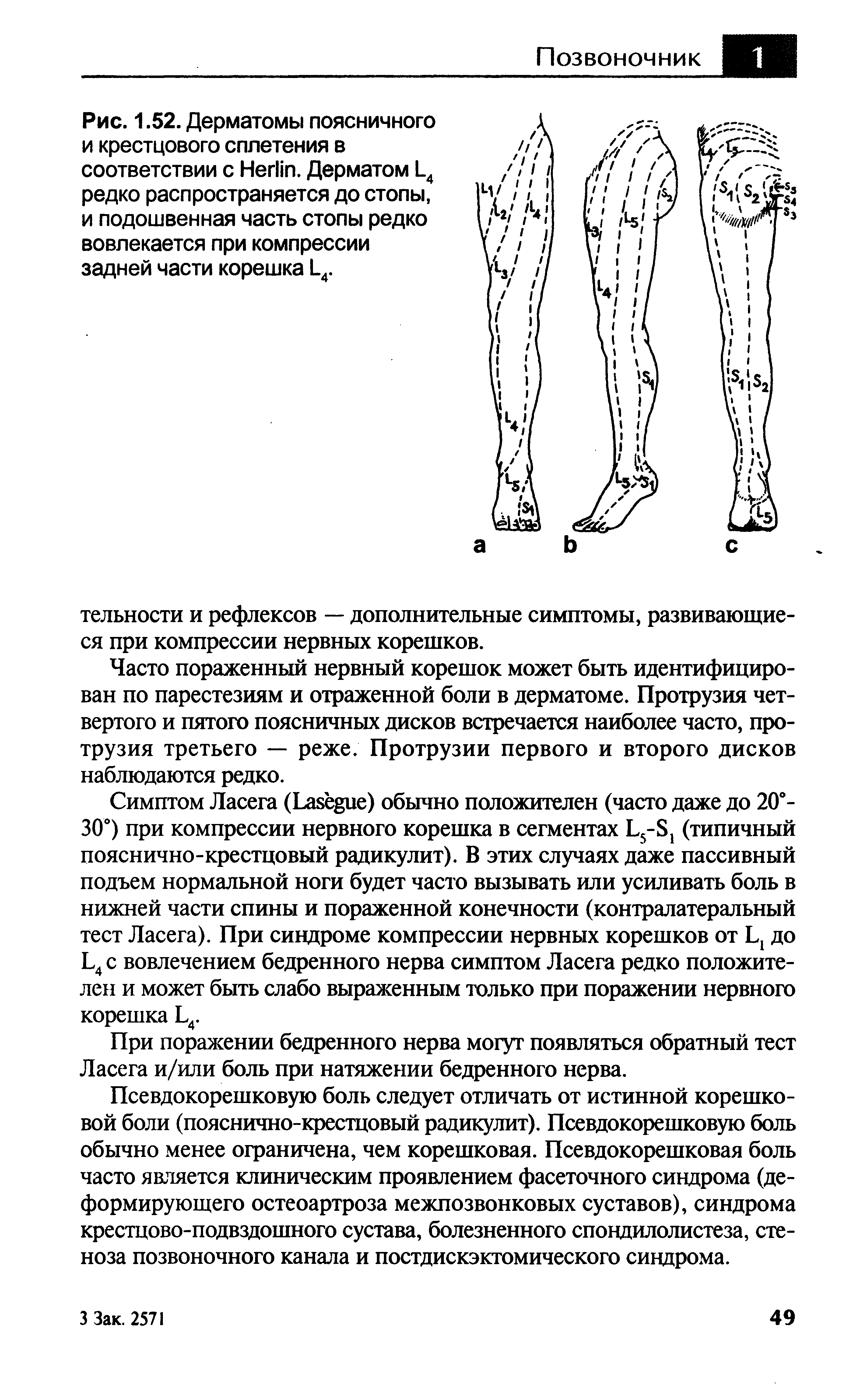 Рис. 1.52. Дерматомы поясничного и крестцового сплетения в соответствии с НегПп. Дерматом 1 4 редко распространяется до стопы, и подошвенная часть стопы редко вовлекается при компрессии задней части корешка 1 4.