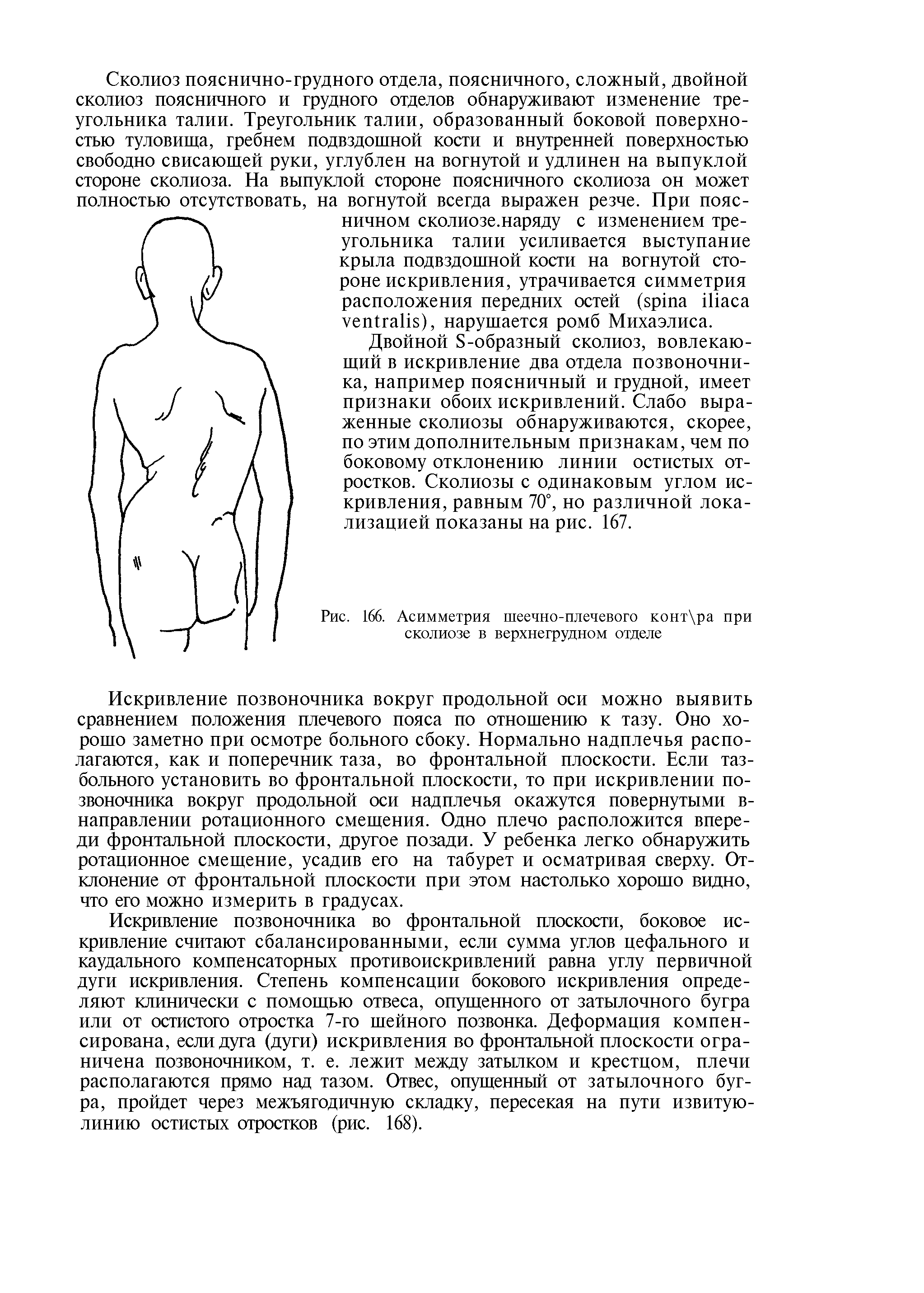 Рис. 166. Асимметрия шеечно-плечевого конт ра при сколиозе в верхнегрудном отделе...