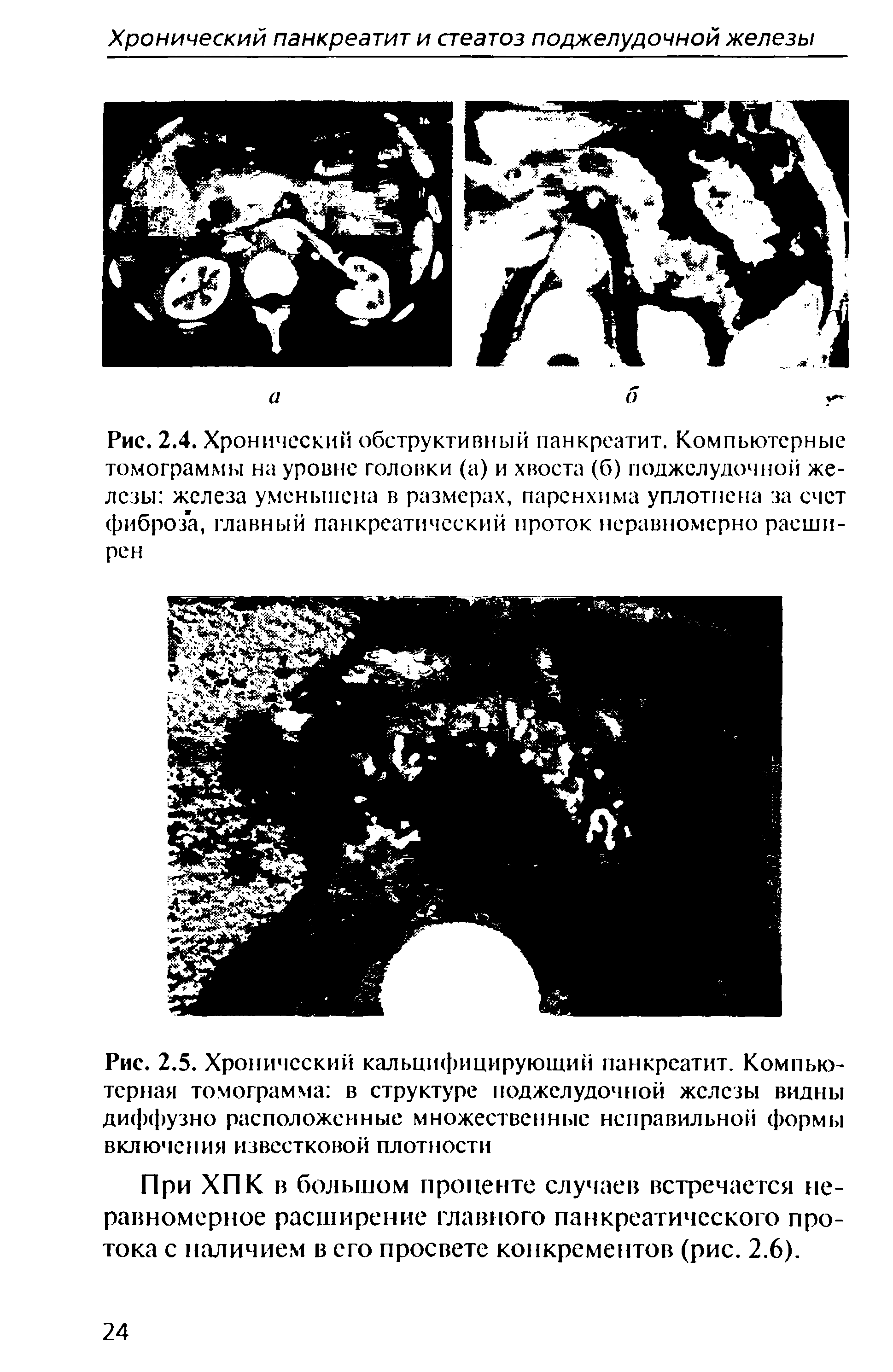 Рис. 2.5. Хронический кальцифицирующий панкреатит. Компьютерная томограмма в структуре поджелудочной железы видны диффузно расположенные множественные неправильной формы включения известковой плотности...