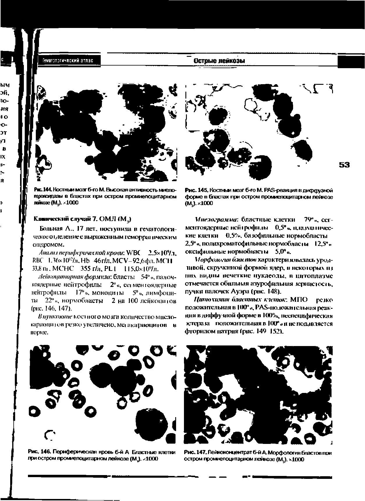 Рис. 144. Костный мозг б-го М. Высокая активность миелопероксидазы в бластах при остром промиепоцитарном лейкозе (М,). >1000...