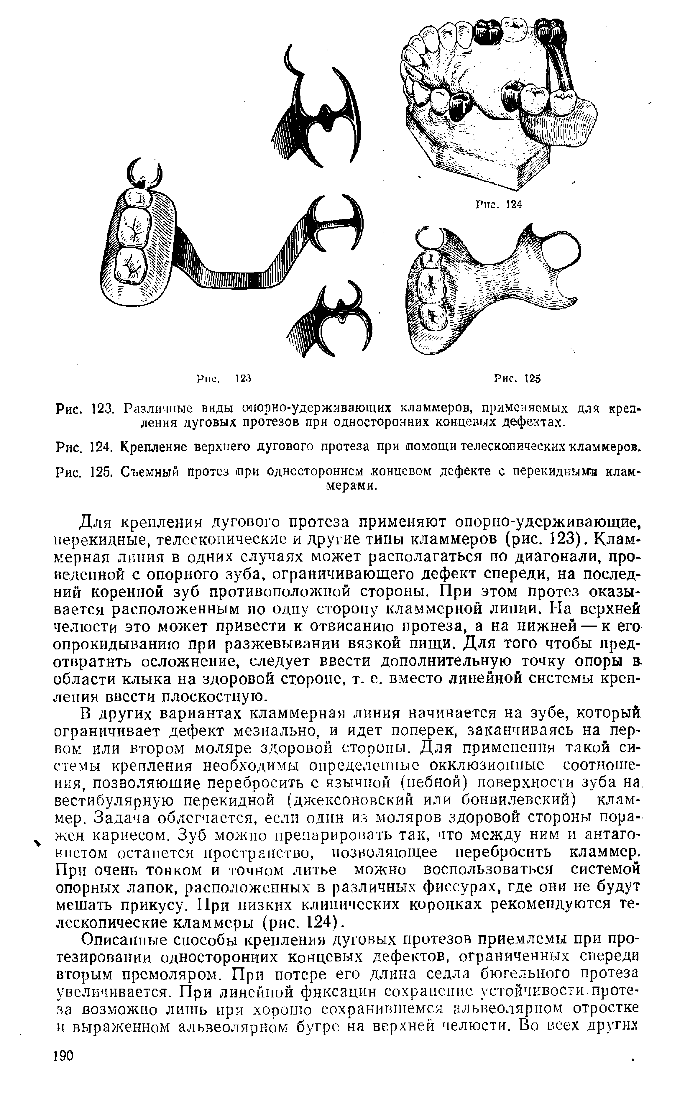 Рис. 124. Крепление верхнего дугового протеза при помощи телескопических кламмеров.