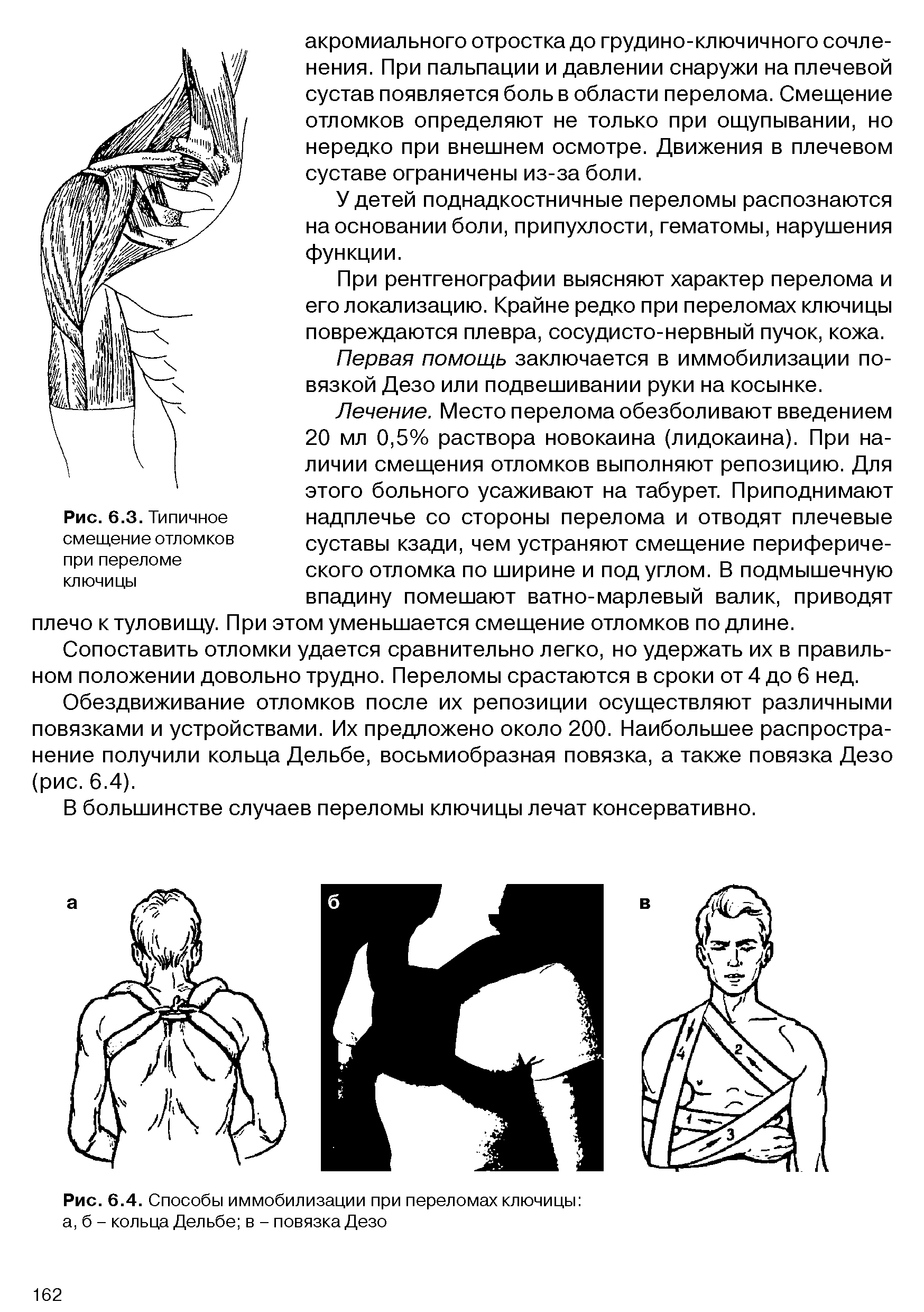 Рис. 6.4. Способы иммобилизации при переломах ключицы а, б - кольца Дельбе в - повязка Дезо...