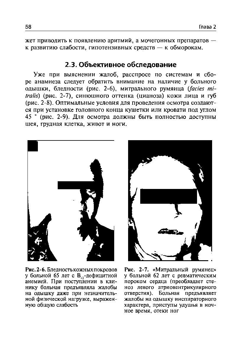 Рис. 2-6. Бледность кожных покровов у больной 65 лет с В12-дефицитной анемией. При поступлении в клинику больная предъявляла жалобы на одышку даже при незначительной физической нагрузке, выраженную общую слабость...