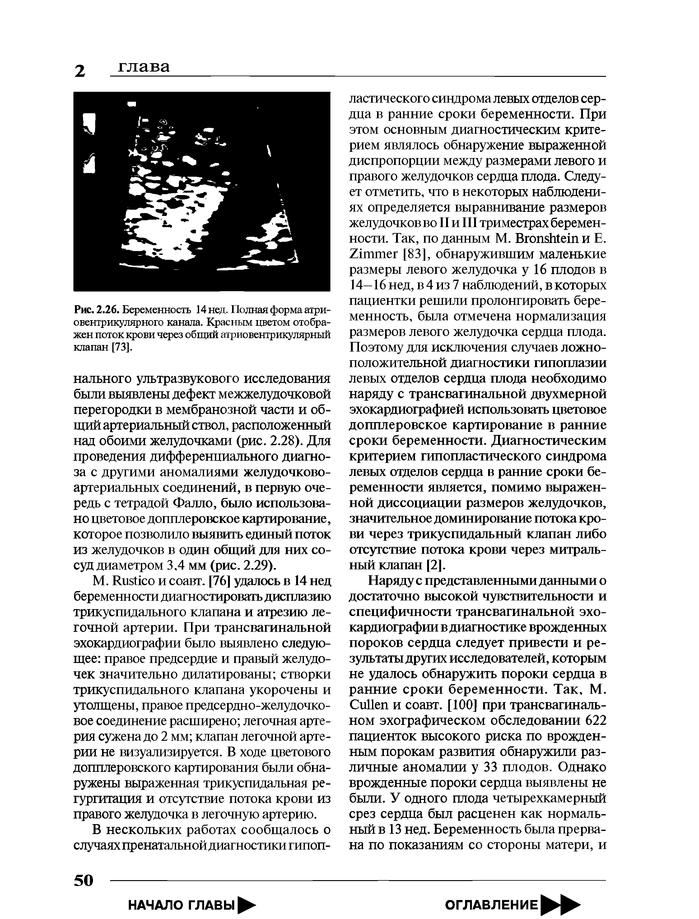 Рис. 2.26. Беременность 14 нед. Полная форма атриовентрикулярного канала. Красным цветом отображен поток крови через общий атриовентрикулярный клапан [73].