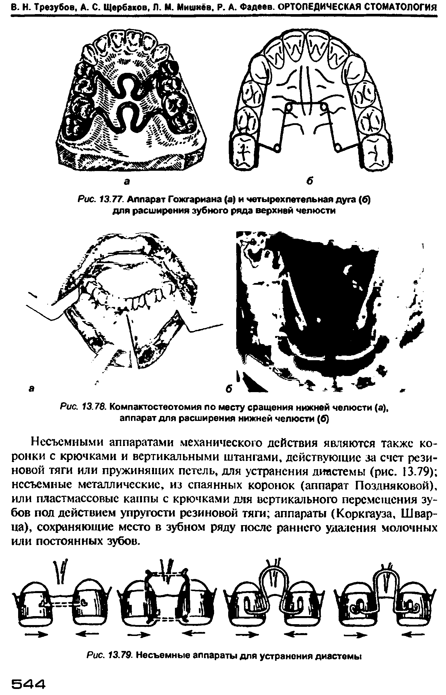 Рис. 13.78. Компактостеотомия по месту сращения нижней челюсти (а), аппарат для расширения нижней челюсти (б)...