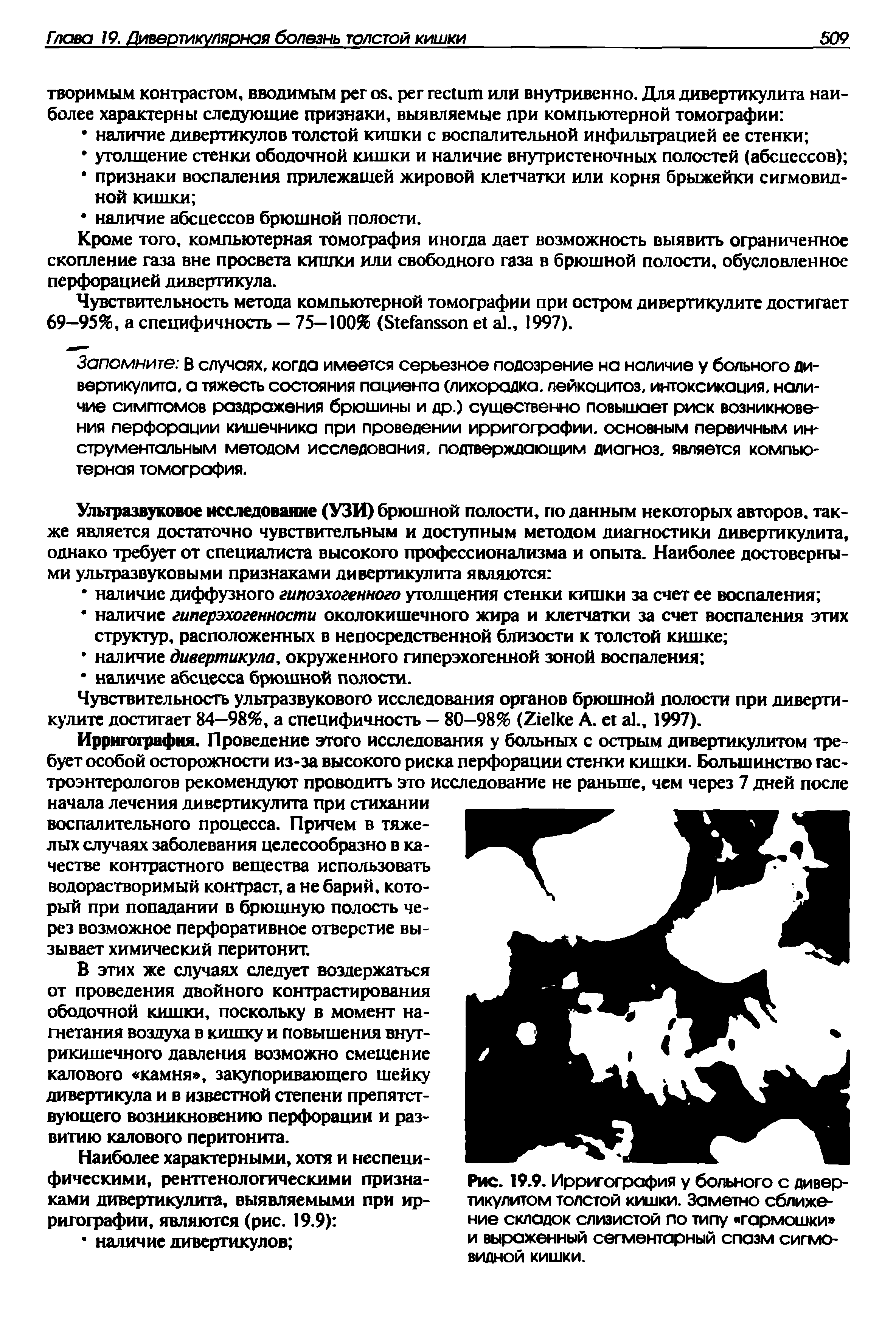 Рис. 19.9. Ирригография у больного с дивертикулитом толстой кишки. Заметно сближение складок слизистой по типу гармошки и выраженный сегментарный спазм сигмовидной кишки.