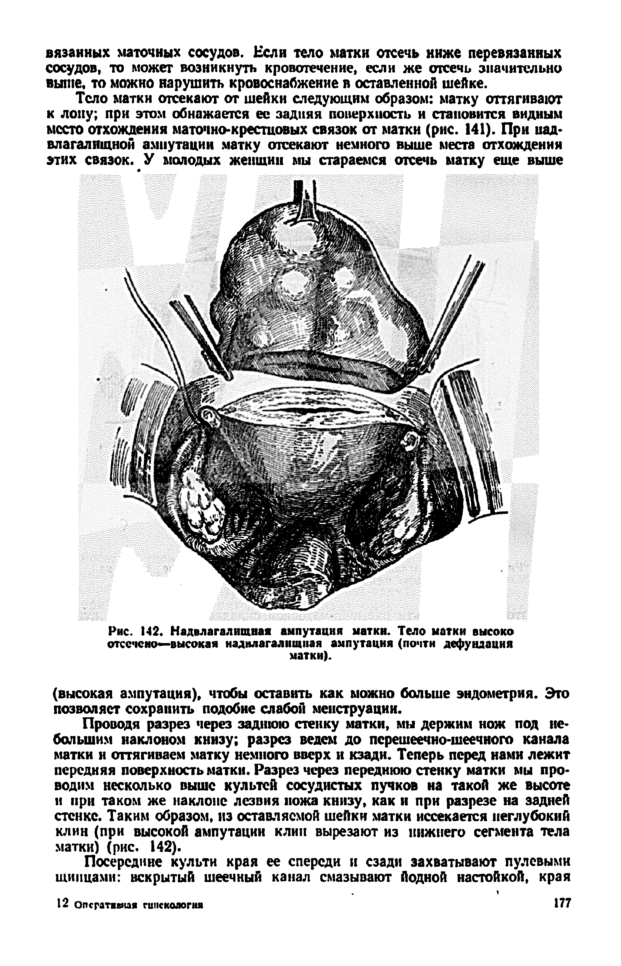Рис. 142. Надвлагалищная ампутация матки. Тело матки высоко отсечено—высокая наднлагалищпая ампутация (почти дефундацня матки).