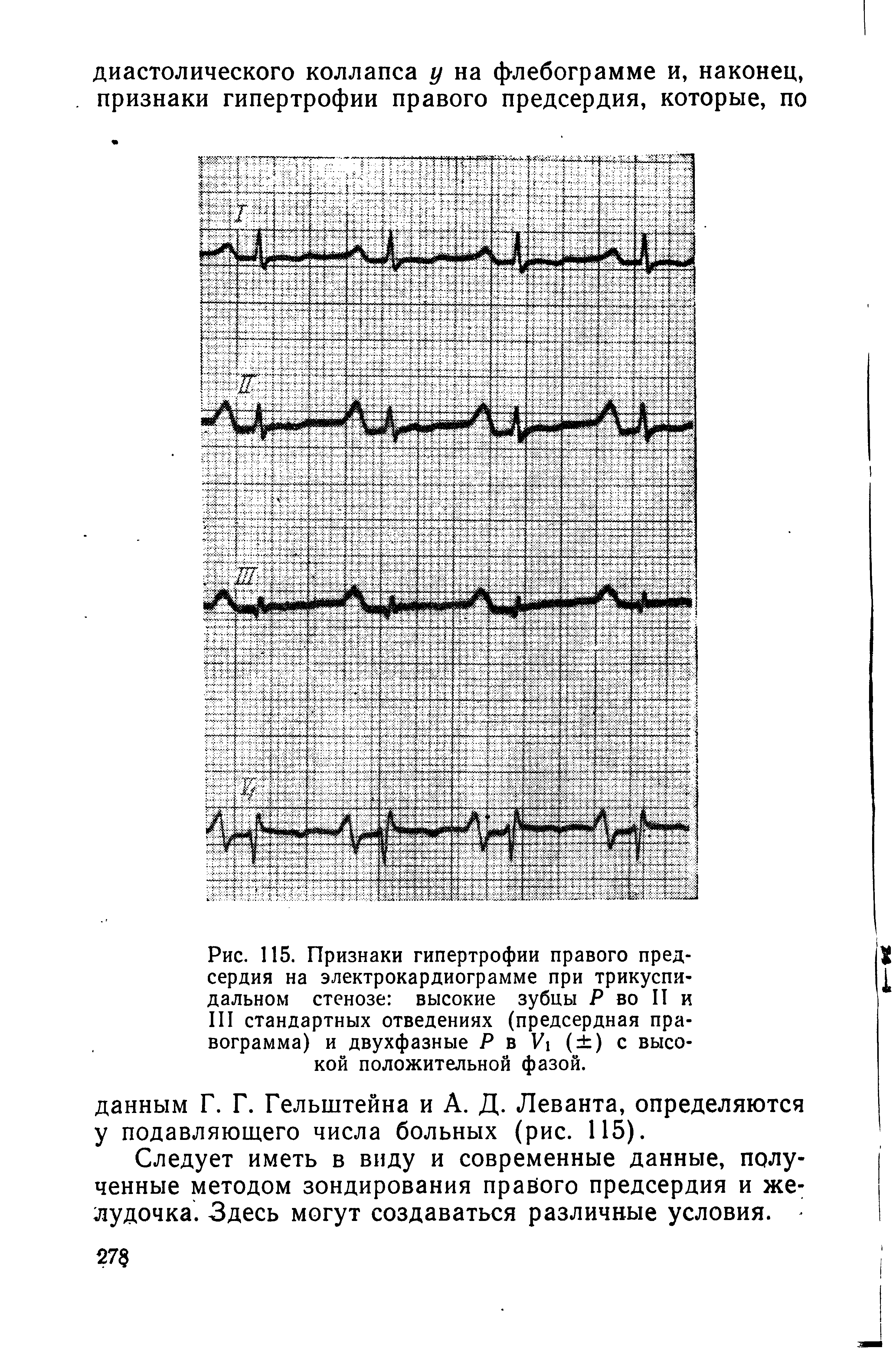 Рис. 115. Признаки гипертрофии правого предсердия на электрокардиограмме при трикуспидальном стенозе высокие зубцы Р во II и III стандартных отведениях (предсердная пра-вограмма) и двухфазные Р в V ( ) с высокой положительной фазой.