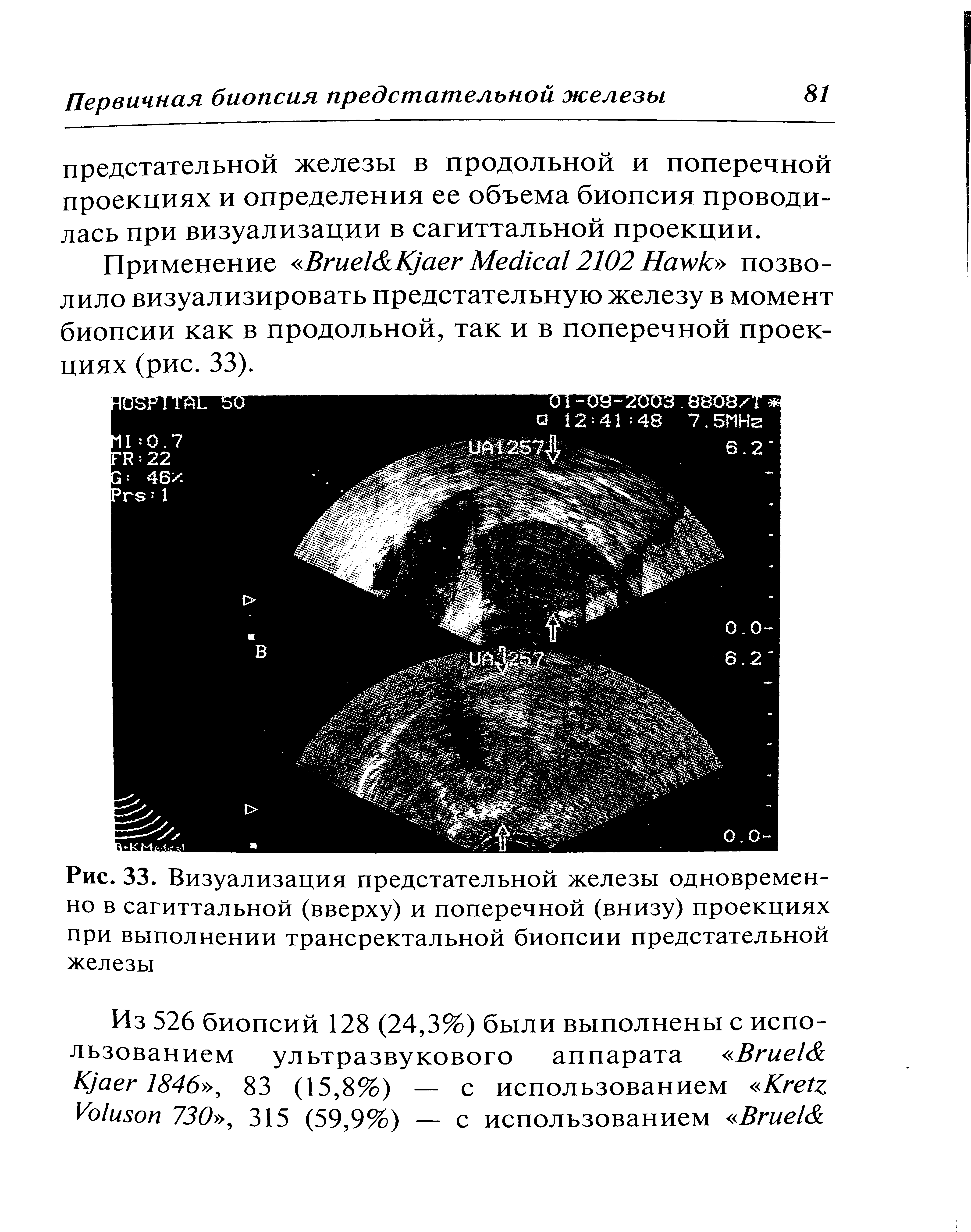 Рис. 33. Визуализация предстательной железы одновременно в сагиттальной (вверху) и поперечной (внизу) проекциях при выполнении трансректальной биопсии предстательной железы...