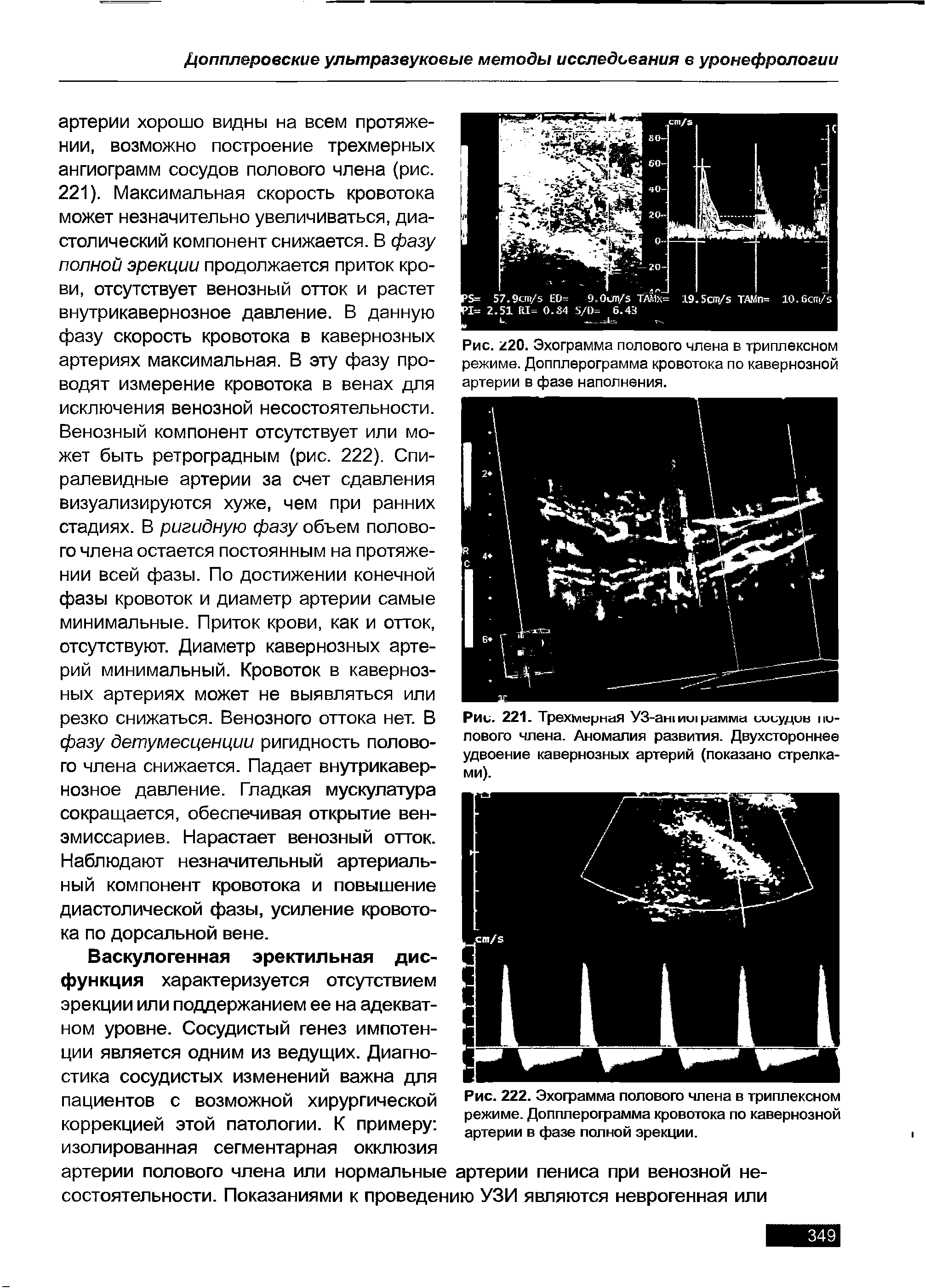 Рис. 221. Трехмерная УЗ-ЭН ии> рамма иииудие I ю-лового члена. Аномалия развития. Двухстороннее удвоение кавернозных артерий (показано стрелками).