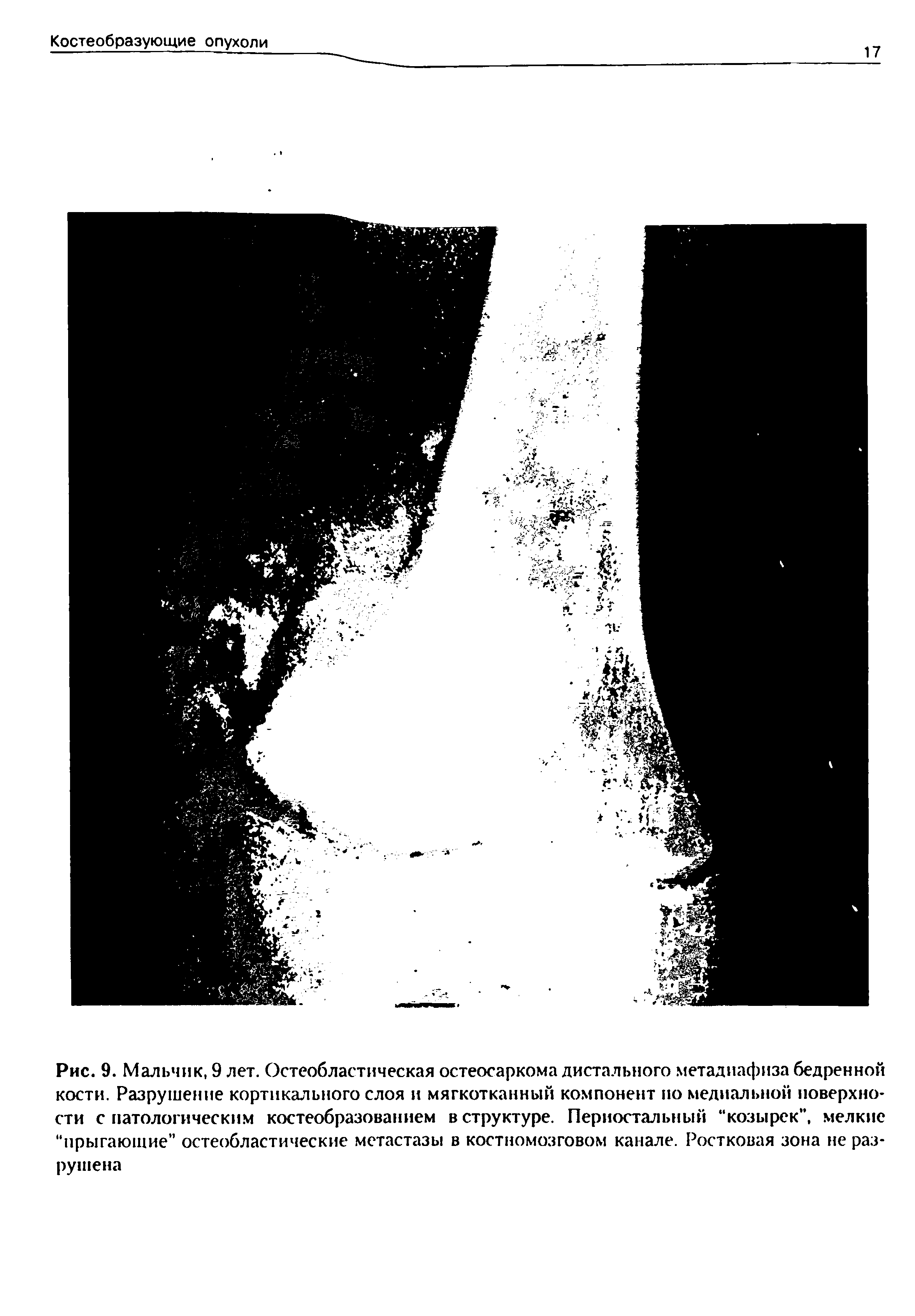 Рис. 9. Мальчик, 9 лет. Остеобластическая остеосаркома дистального метадиафиза бедренной кости. Разрушение кортикального слоя и мягкотканный компонент по медиальной поверхности с патологическим костеобразованием в структуре. Периостальный козырек , мелкие "прыгающие остеобластические метастазы в костномозговом канале. Ростковая зона не разрушена...