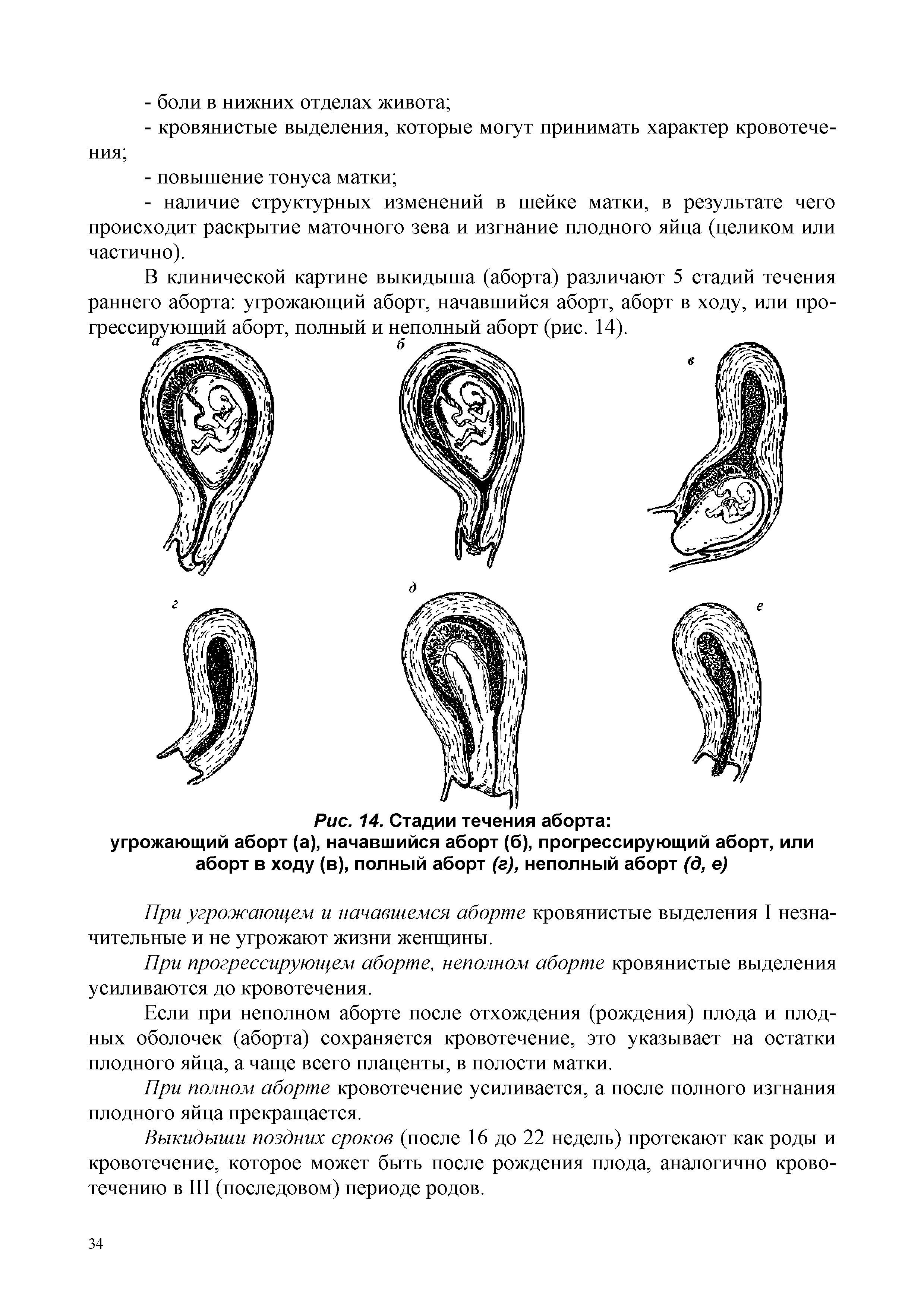Рис. 14. Стадии течения аборта угрожающий аборт (а), начавшийся аборт (б), прогрессирующий аборт, или аборт в ходу (в), полный аборт (г), неполный аборт (д, е)...