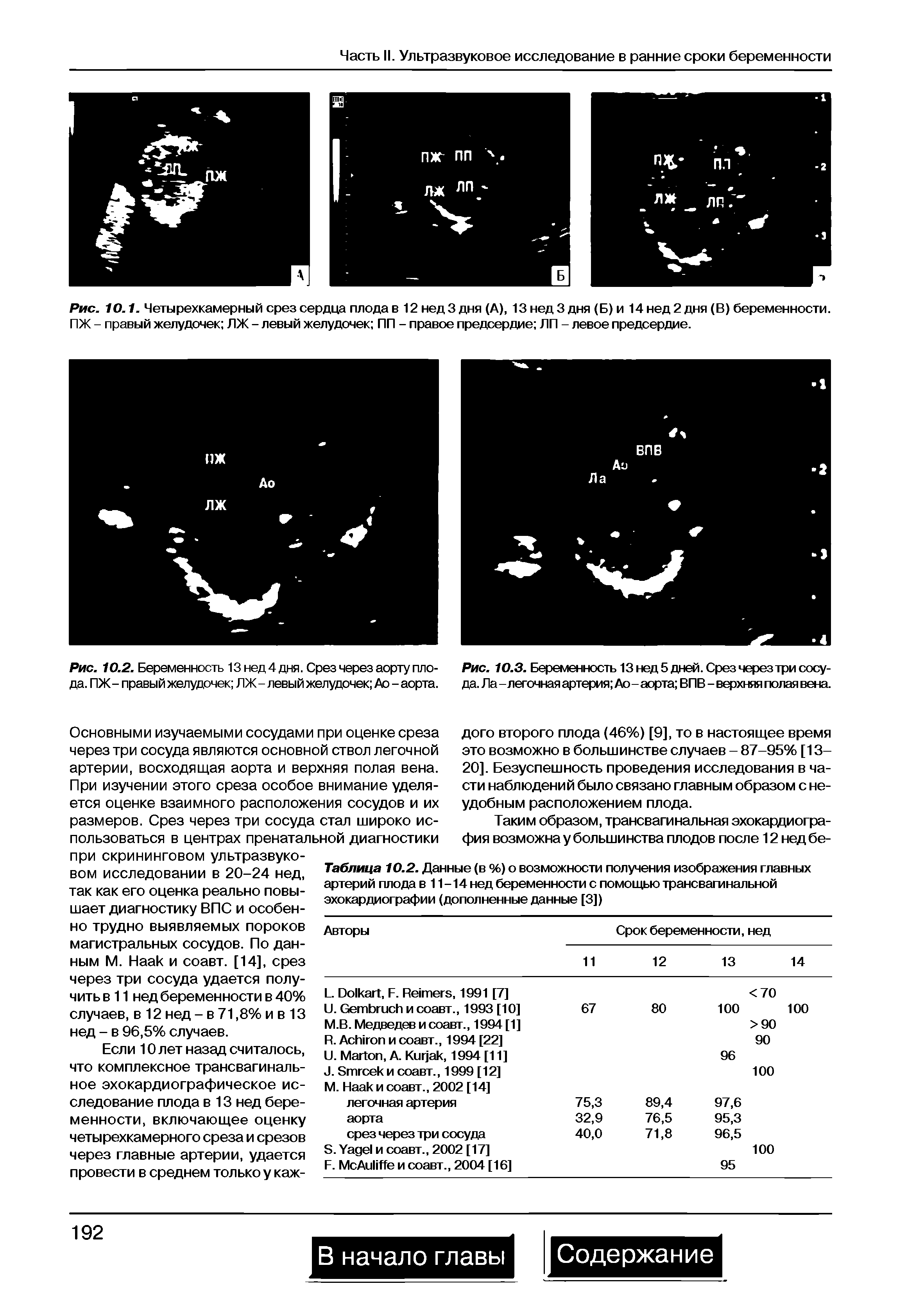 Рис. 10.3. Беременность 13 нед 5 дней. Срез через три сосуда. Ла - легочная артерия Ао- аорта ВПВ - верхняя полая вена.