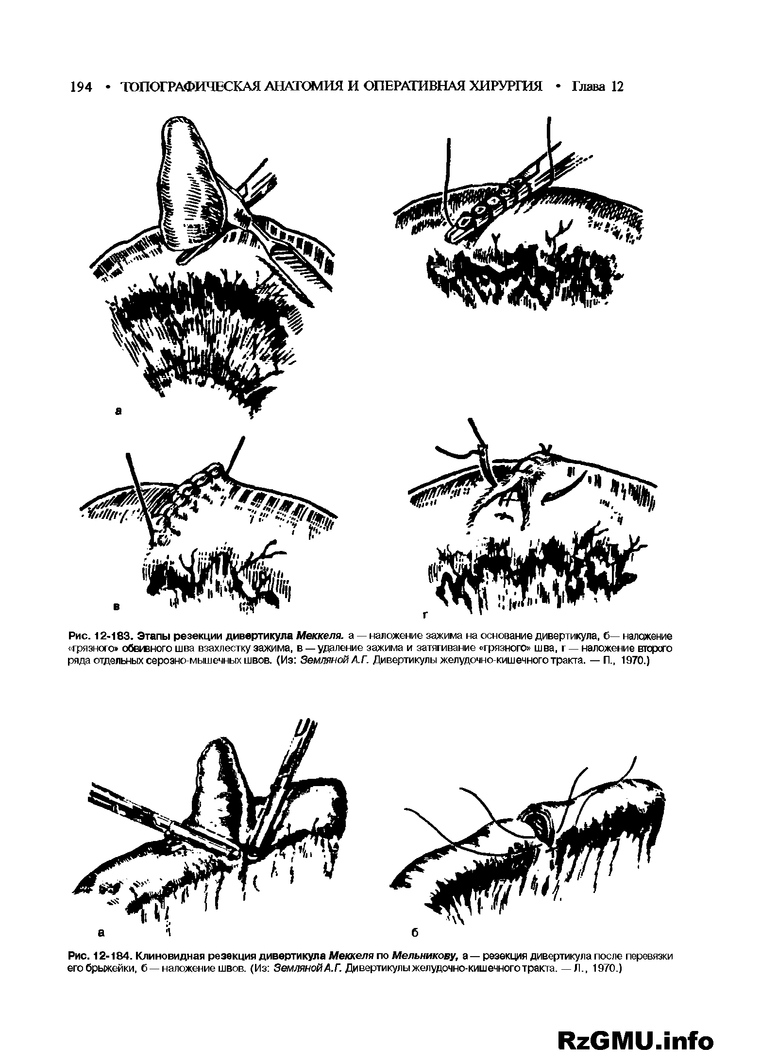 Рис. 12-184. Клиновидная резекция дивертикула Меккеля по Мельникову, а — резекция дивертикула после перевязки его брыжейки, б —наложение швов. (Из Земляной А.Г. Дивертикулы желудочно-кишечного тракта. — Л., 1970.)...