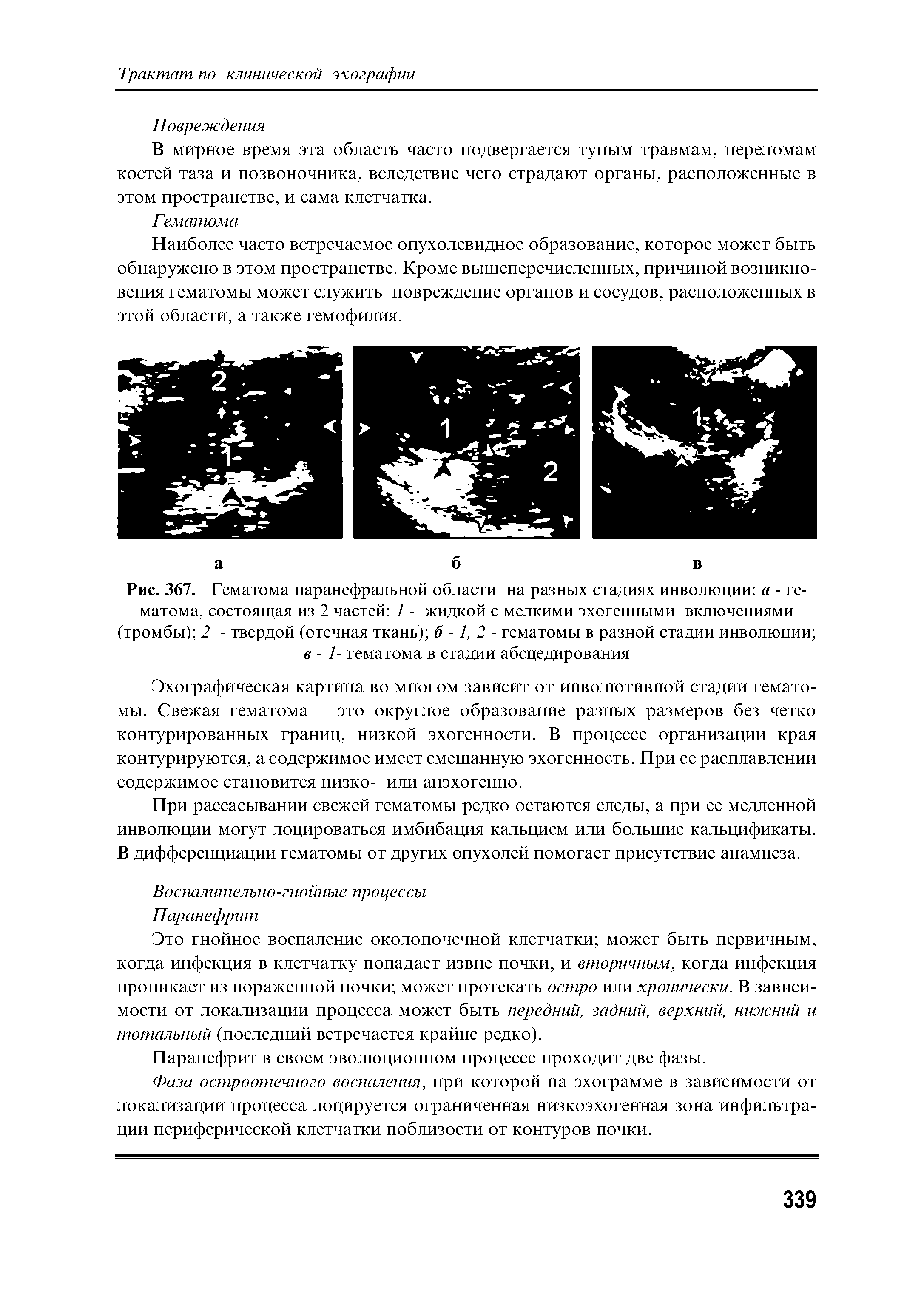 Рис. 367. Гематома паранефральной области на разных стадиях инволюции а - гематома, состоящая из 2 частей 1 - жидкой с мелкими эхогенными включениями (тромбы) 2 - твердой (отечная ткань) 6-1,2- гематомы в разной стадии инволюции в - 1- гематома в стадии абсцедирования...