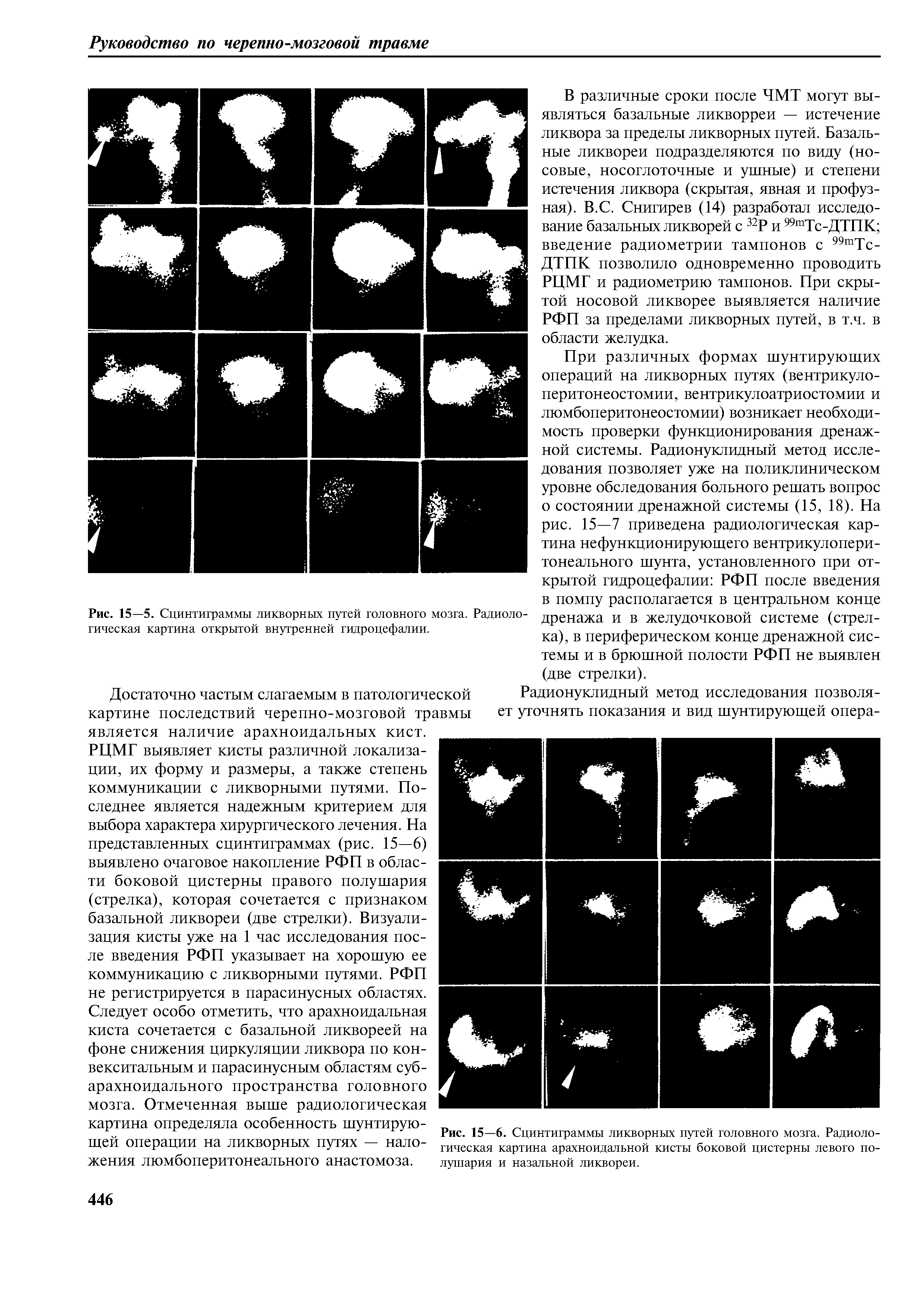 Рис. 15—6. Сцинтиграммы ликворных путей головного мозга. Радиологическая картина арахноидальной кисты боковой цистерны левого полушария и назальной ликвореи. ...