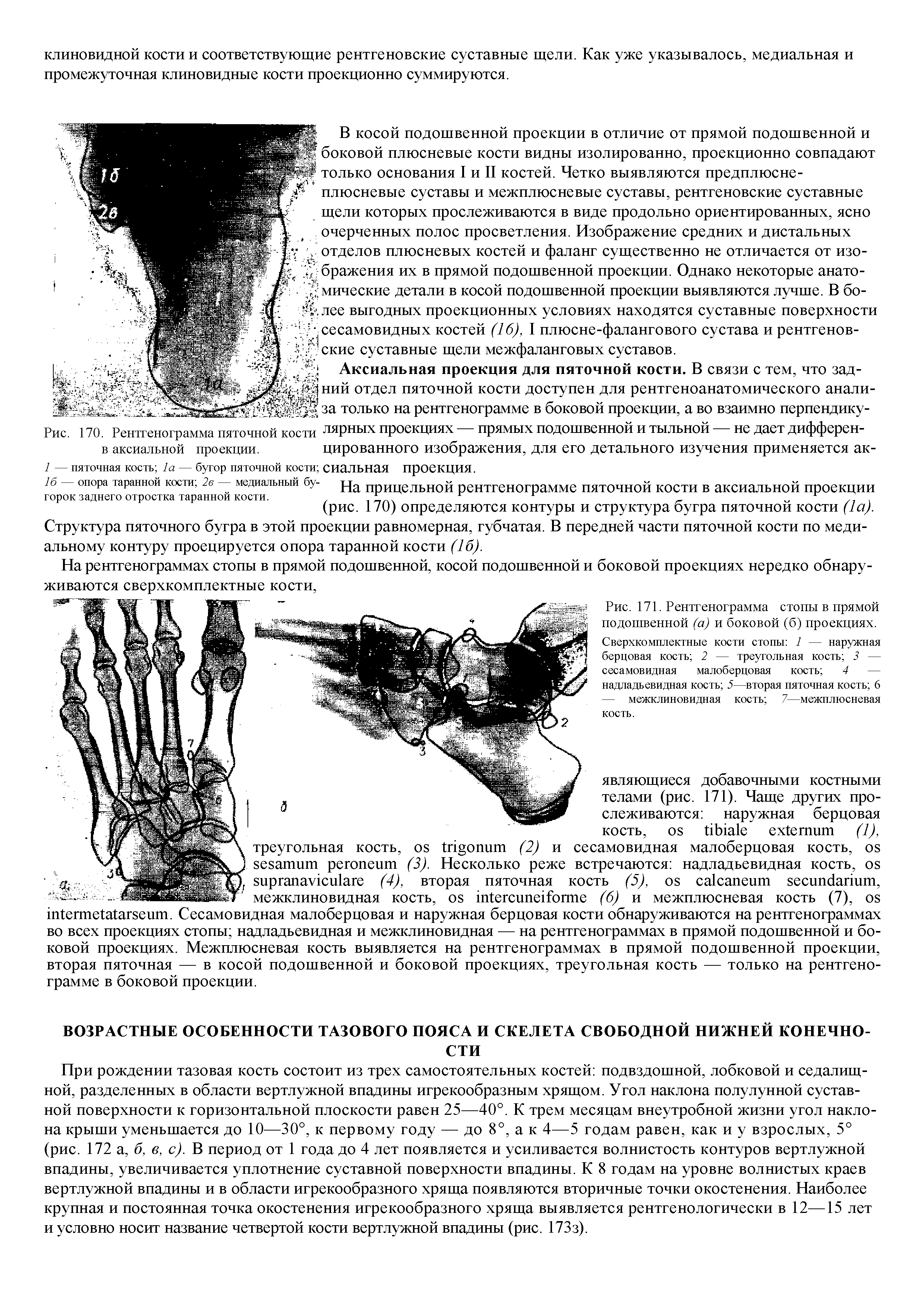 Рис. 171. Рентгенограмма стопы в прямой подошвенной (а) и боковой (б) проекциях. Сверхкомплектные кости стопы 1 — наружная берцовая кость 2 — треугольная кость 3 — сесамовидная малоберцовая кость 4 —...