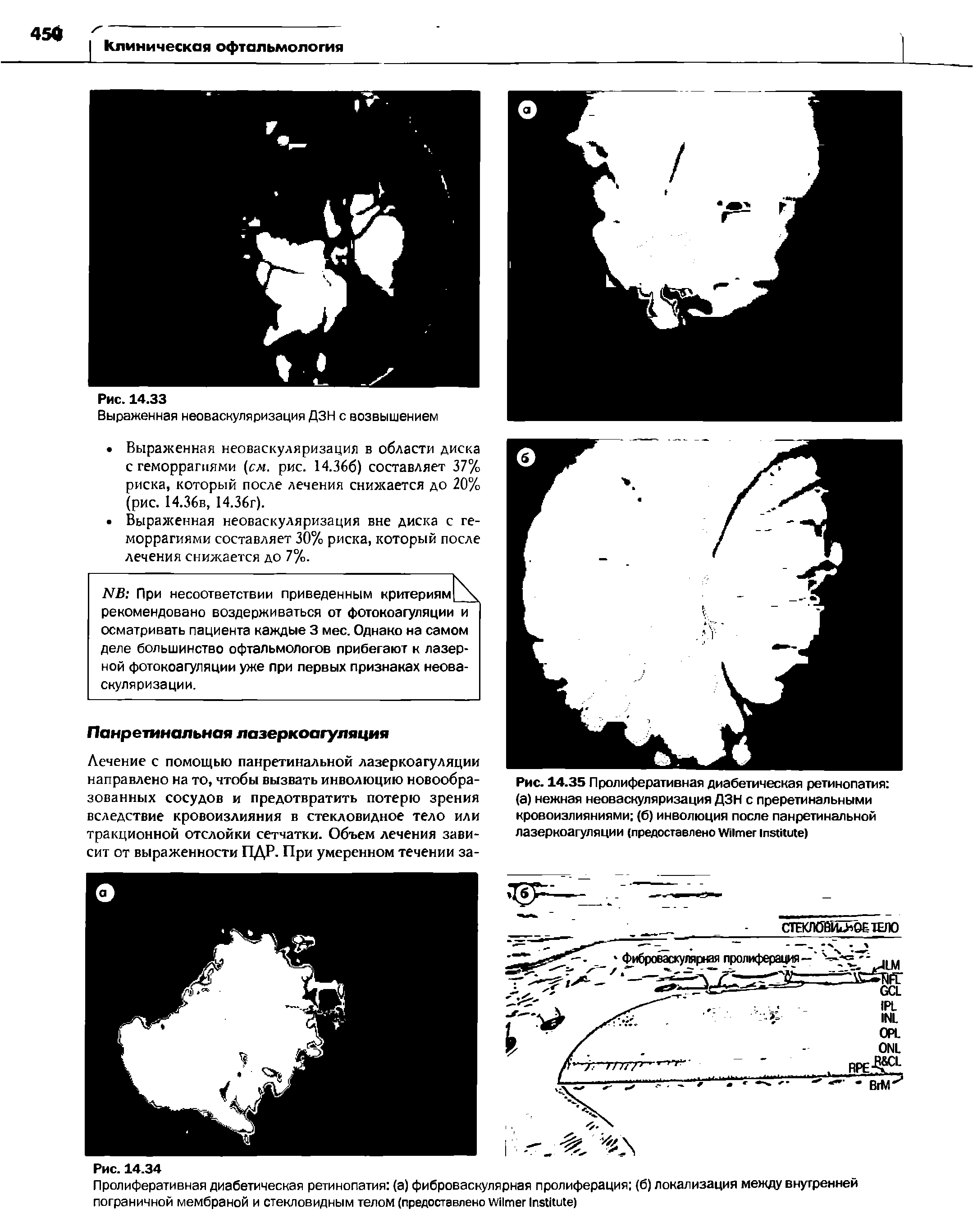 Рис. 14.35 Пролиферативная диабетическая ретинопатия (а) нежная неоваскуляризация ДЗН с преретинальными кровоизлияниями (б) инволюция после панретинальной лазеркоагуляции (предоставлено W I )...