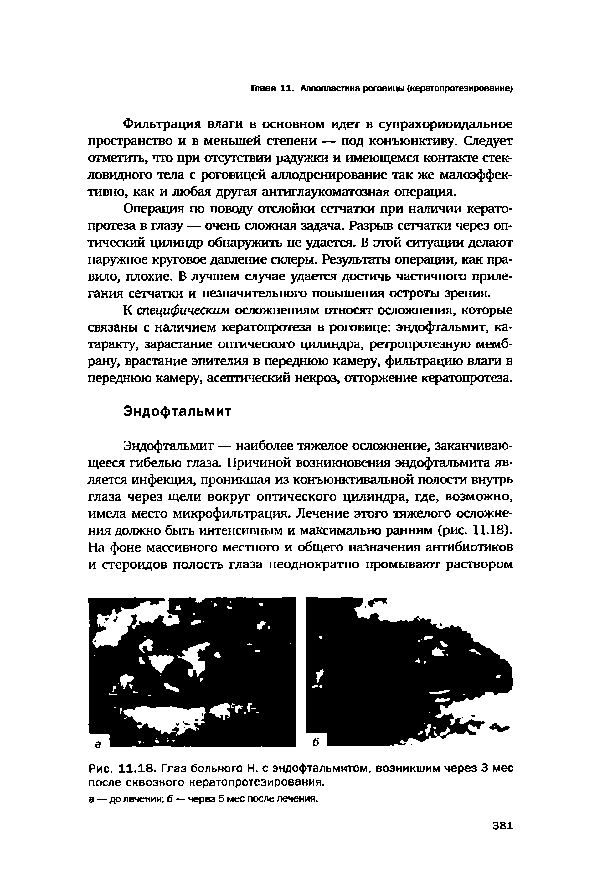 Рис. 11.18. Глаз больного Н. с эндофтальмитом, возникшим через 3 мес после сквозного кератопротезирования.