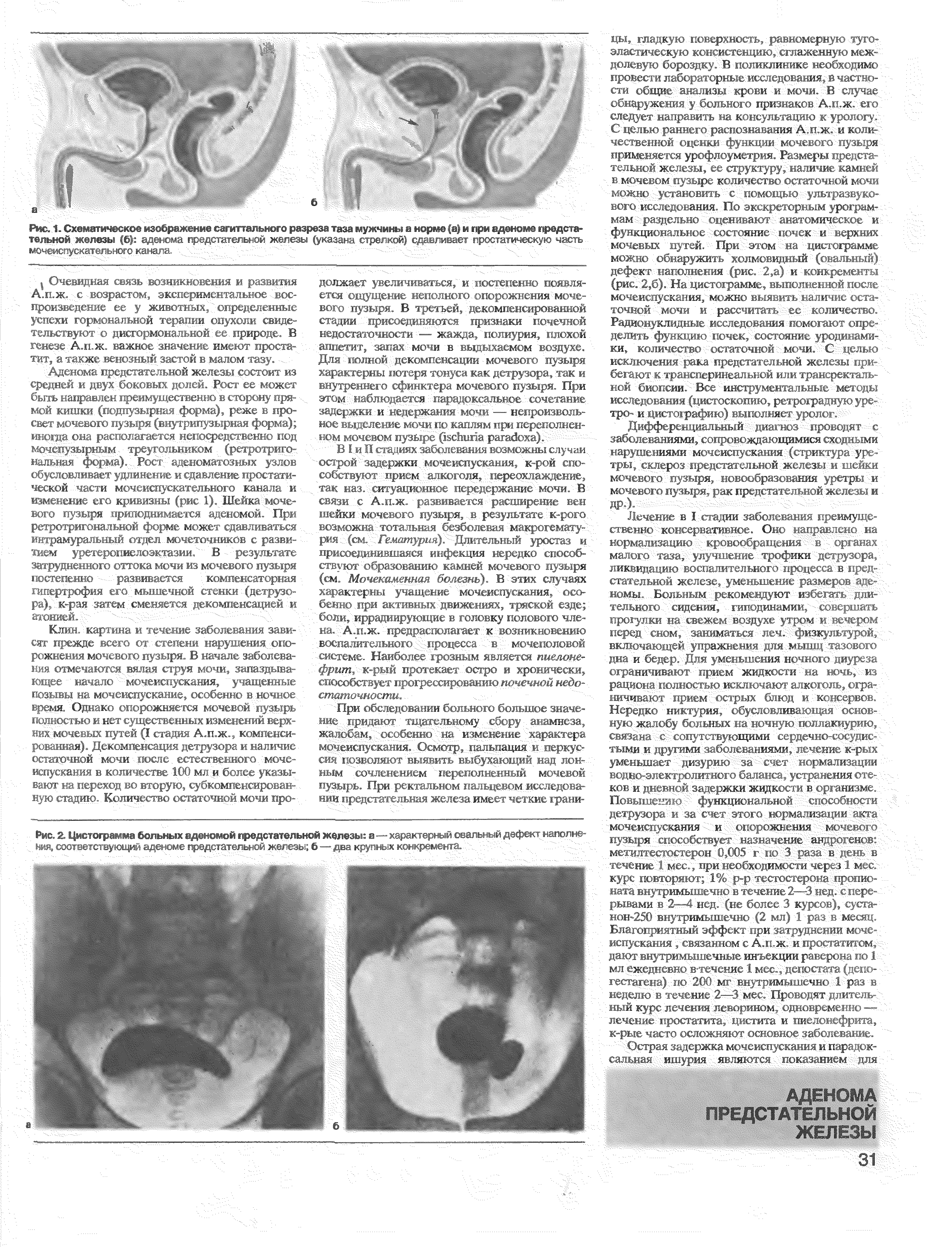 Рис. 2. Цистограмме больных аденомой предстательной железы я—характерный овальный дефект наполнения, соответствующий аденоме предстательной железы б — два крупных конкремента., , ...