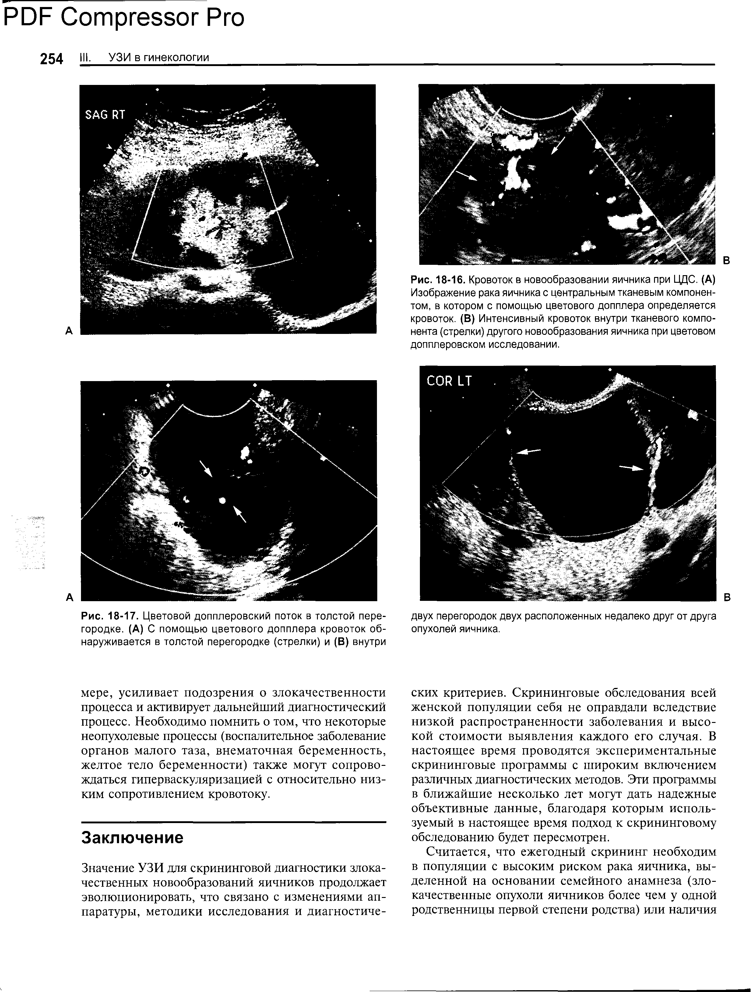 Рис. 18-16. Кровоток в новообразовании яичника при ЦДС. (А) Изображение рака яичника с центральным тканевым компонентом, в котором с помощью цветового допплера определяется кровоток. (В) Интенсивный кровоток внутри тканевого компонента (стрелки) другого новообразования яичника при цветовом допплеровском исследовании.