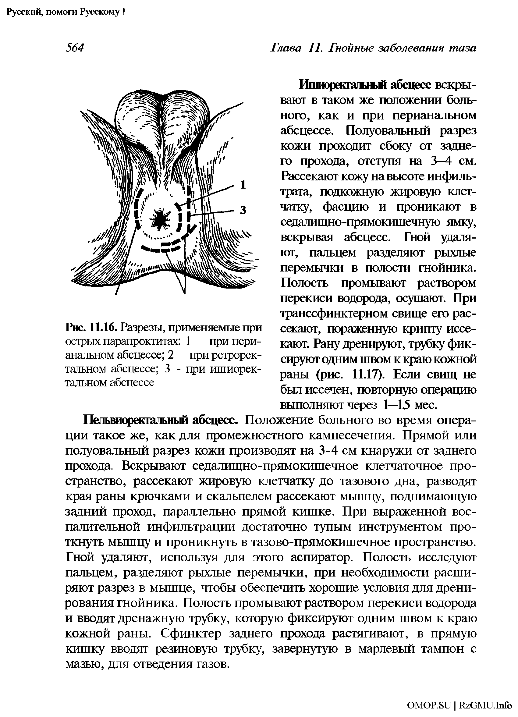 Рис. 11.16. Разрезы, применяемые при острых парапроктитах 1 — при пери-анальном абсцессе 2 при ретрорек-тальном абсцессе 3 - при ишиоректальном абсцессе...