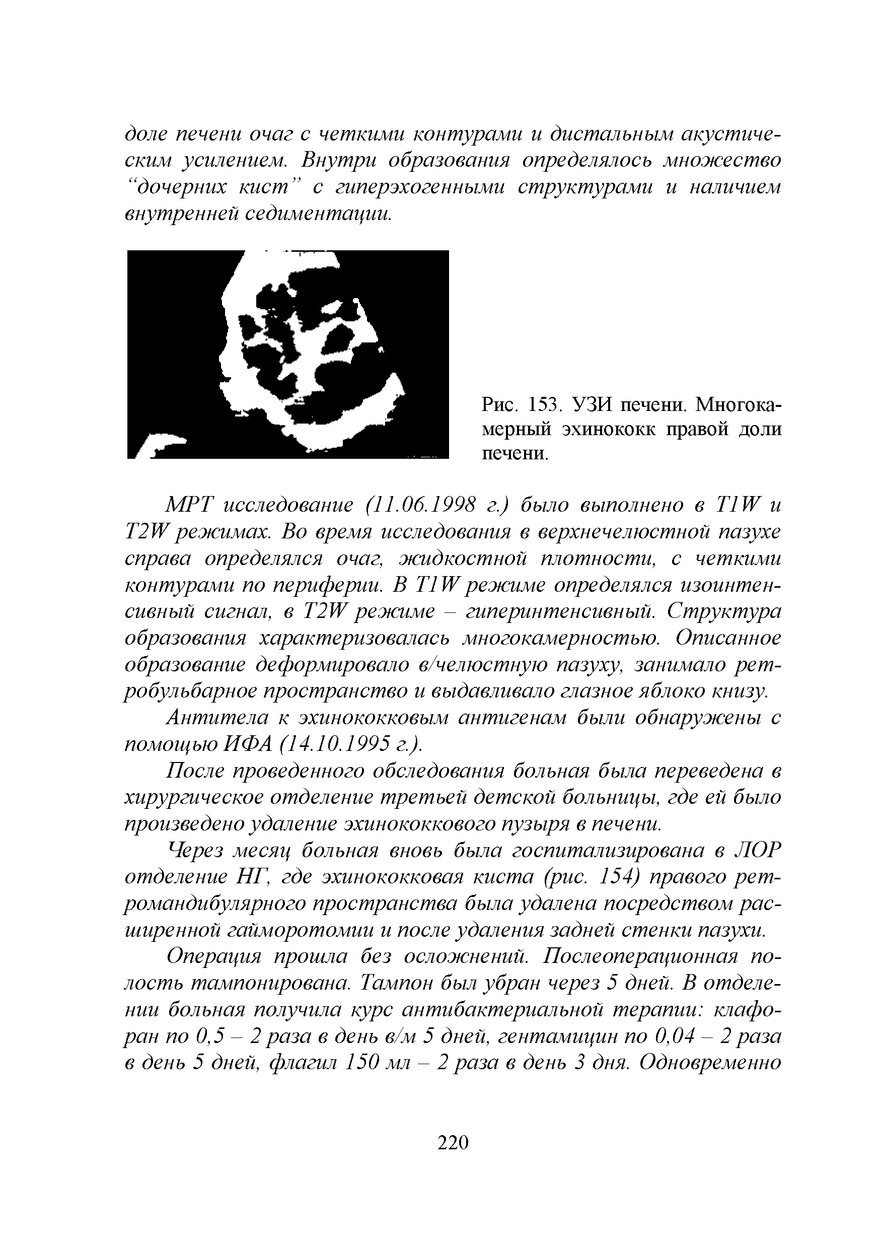 Рис. 153. УЗИ печени. Многокамерный эхинококк правой доли печени.